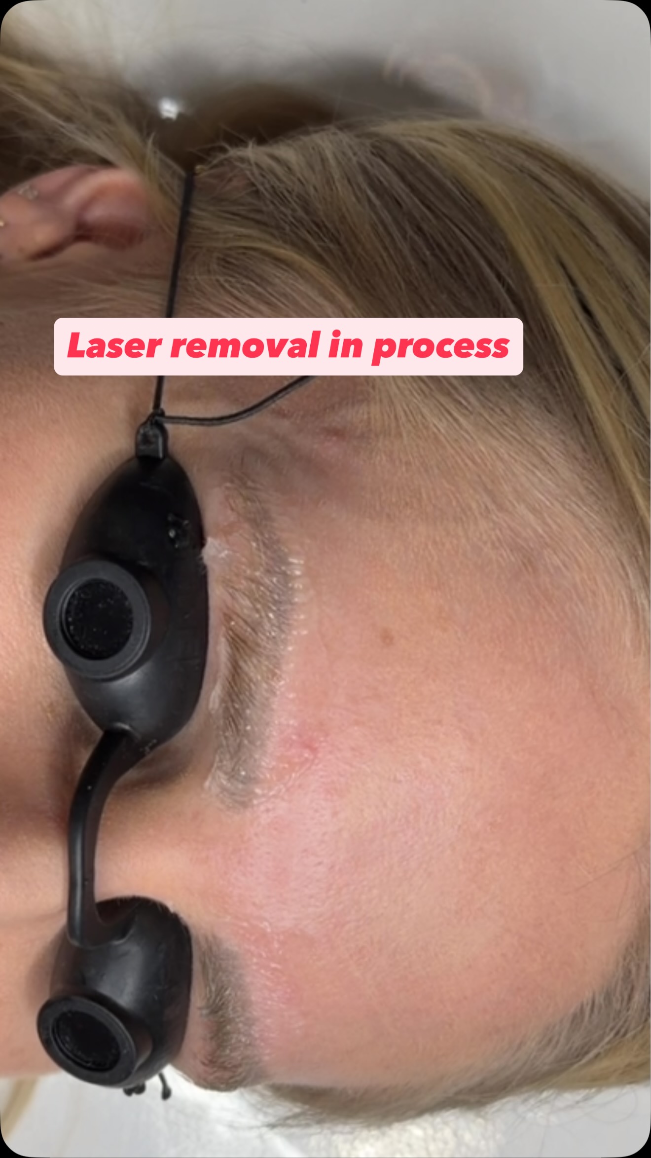 #laserremoval her 9 years old Microblading i did when i first start my PMU career🤩🤩
#browtattooremoval #laserremoval #cosmetictattooremoval #wellington