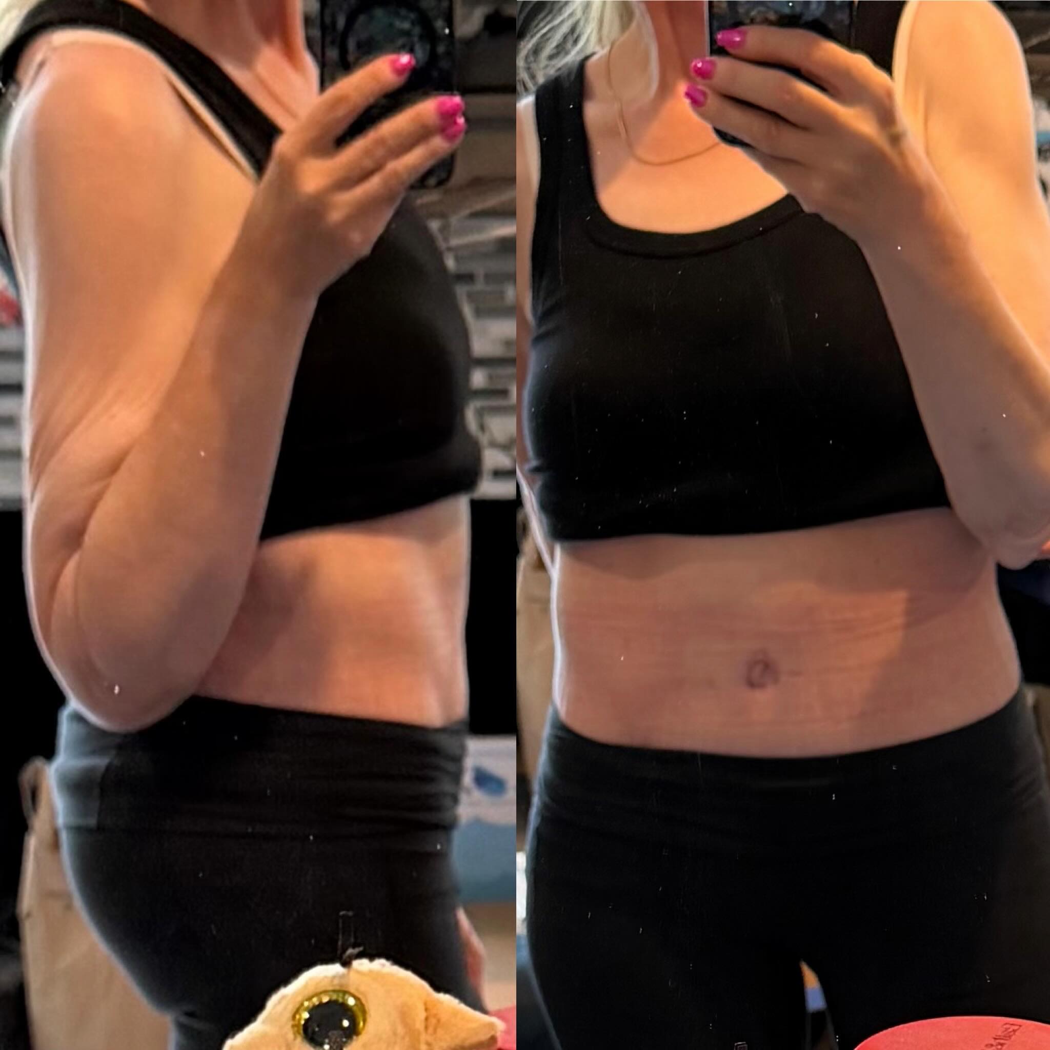 I’ve been slowly changing over the past 3 years. I’m still healing from my first of 3 skin removal surgeries after losing 240 lbs. I feel like I’ve been hiding for the last 45 years. Now I’m just trying to figure out who I am again. Today is a good day. They are not all this way. I’m trying to be more open about myself. #SkinRemoval #MassiveWeightLoss #NewSelf #IThinkICanKrystal #IDidItWhat’sNext.