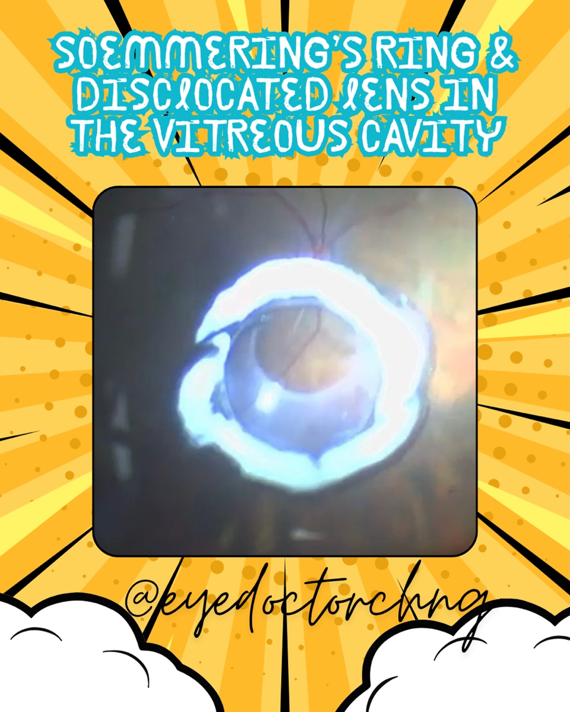 This is a dislocated intraocular lens (IOL) into the vitreous cavity (or “deep inside the eye”) with a unique white ring called the Soemmering’s Ring. This ring is formed by leftover lens cells and material from a cataract surgery that has grown over time to produce this unique white lens fiber material.
When an IOL is dislocated into the vitreous cavity, the person will have very poor vision and an ophthalmologist with a sub-specialist interest in vitreoretinal surgery will be needed to perform the surgery to restore vision.
Full video coming soon!
#soemmeringring #dislocatediol #vitreoretinalsurgery #ophthalmology #eyedoctorchng