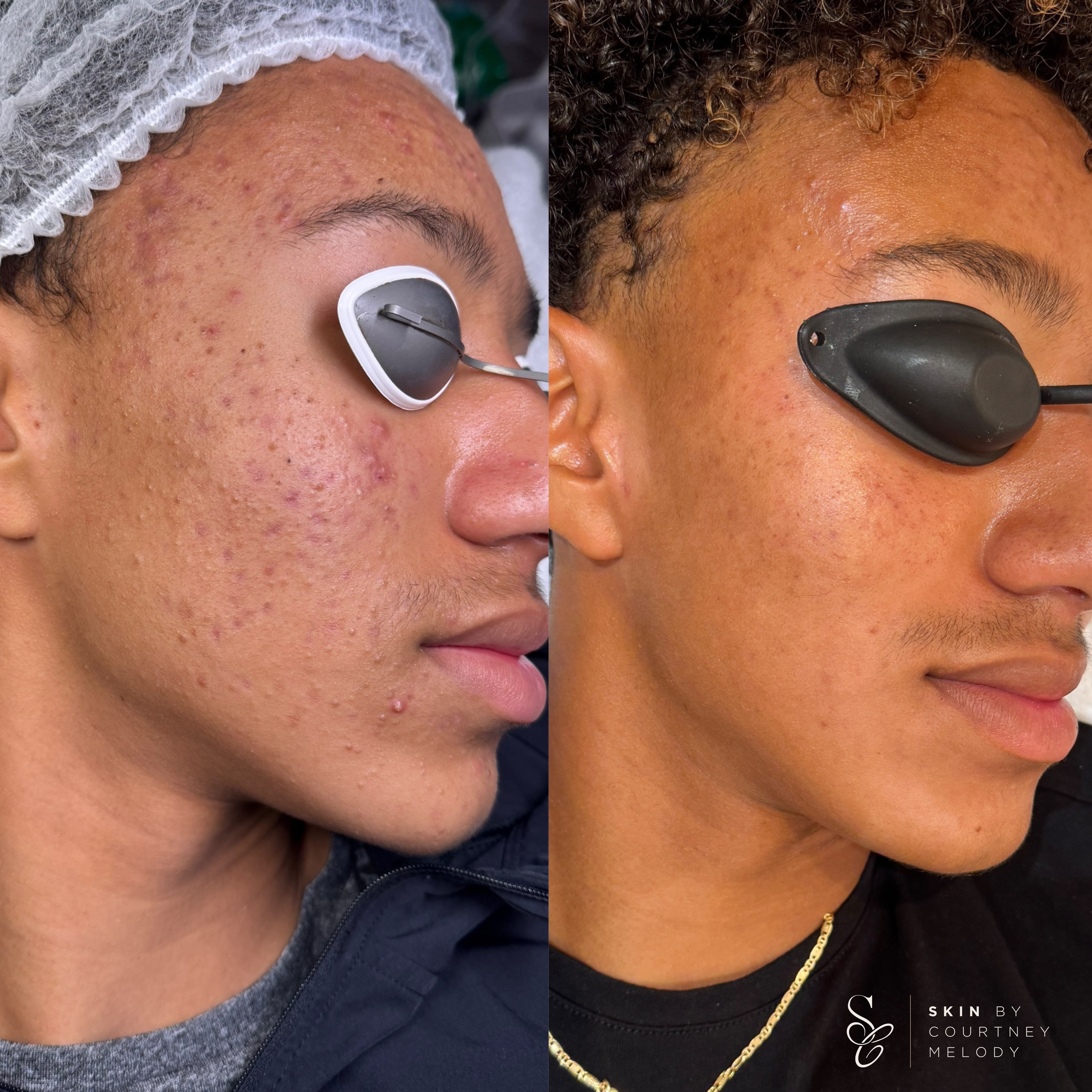 Wondering what achieved these results? 🎯
Consistency, hard work & patience 👏🏻
We tackled this with a whole approach, monthly treatments, a whole new skincare regime, nutrition and lifestyle changes. This client truly put in the work and the results show it! My teen clients always work so hard 🤗
His review ⬇️
“So happy with the results. My face feels a lot smoother, clearer and brighter. Not only that, it boosts my confidence. Definitely coming back”
Love my job! - #acne #cheltenham #acnespecialist #cheltenhamacne #teenageskin closedcomedones inflamedacne acneresults