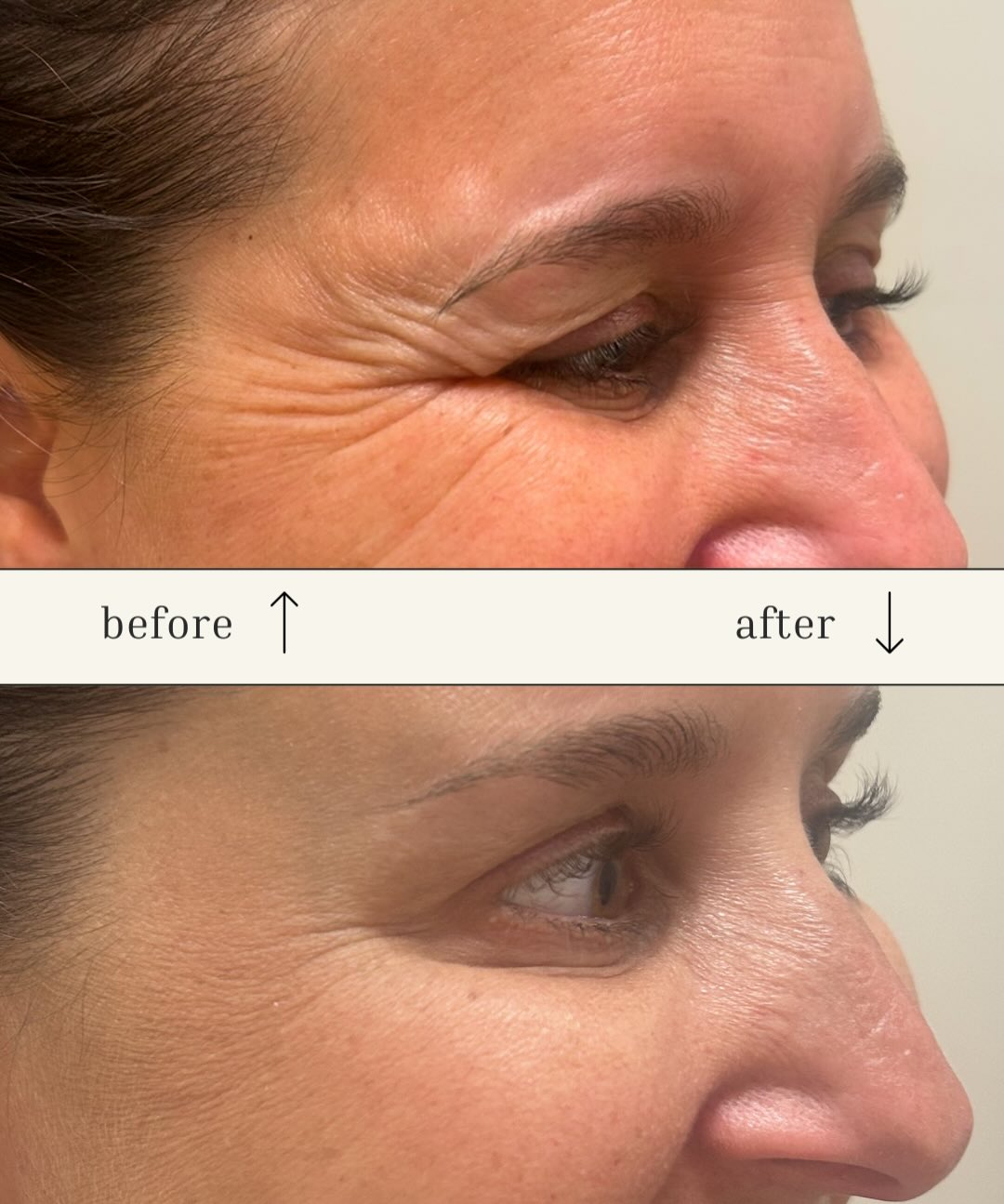 full upper face tox 3 weeks later
if you’re looking for a sign- here it is 🪧