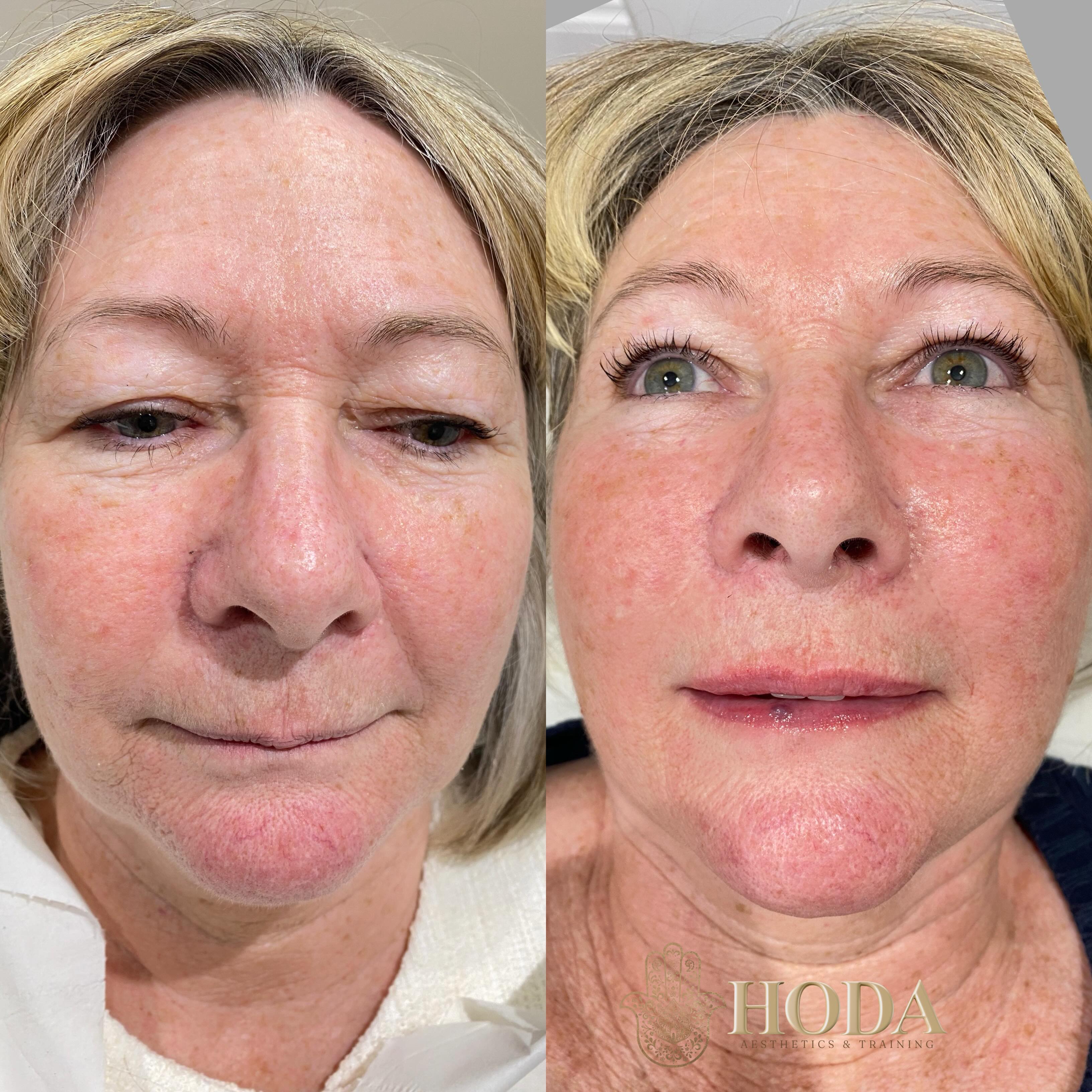 โจ WOWโฆ look at these results after just 2 sessions of Profhilo skin booster โจ
The transformation here is all about healthy, hydrated, glowing skin โ smoother texture, improved elasticity, softened fine lines and that beautiful natural radiance ๐ซ
Profhilo works by delivering ultra-pure hyaluronic acid beneath the skin to stimulate collagen and elastin production. Rather than adding volume or changing facial shape, it remodels and rejuvenates the skin from within for a fresher, firmer appearance.
For this treatment journey, we completed 2 Profhilo sessions spaced 4 weeks apart to achieve optimal skin quality and hydration ๐
We also added 0.5ml to the lips, keeping everything subtle, soft and natural โ enhancing shape and hydration without looking overdone ๐โจ
Natural results are always the goal ๐ค
#profhilotreatment #bournemouth #bournemouthclinic #lipfillerbournemouth #bournemouthsalon