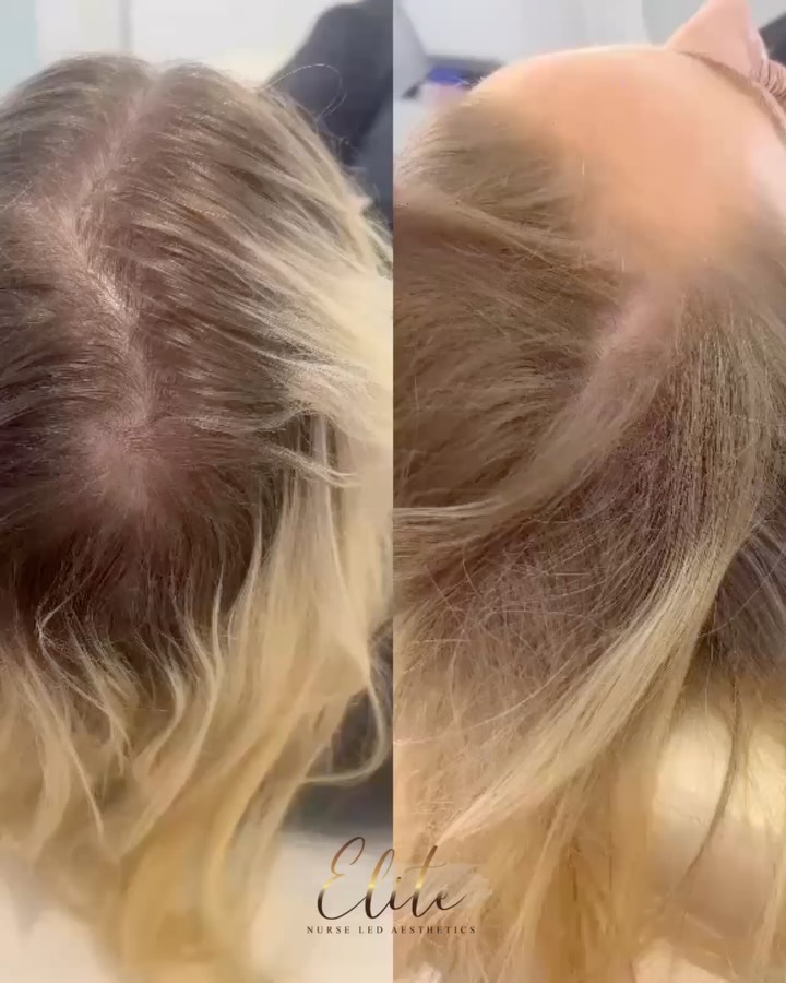 Struggling with hair thinning? These results speak for themselves 👀✨
Exosomes microneedling is an advanced treatment designed to support hair growth, improve scalp health and help restore confidence naturally 💉
By combining microneedling with powerful exosomes, this treatment works to stimulate the hair follicles, encourage regeneration and improve the appearance of thinning areas over time.
✔️ Supports healthier hair growth
✔️ Improves scalp condition
✔️ Encourages follicle stimulation
✔️ Minimally invasive treatment
✔️ Natural-looking results
Consistency is key, and these results are proof that investing in your hair journey is worth it 🙌
📍 Wakefield
💌 DM Elite Nurse Led Aesthetics to book your consultation or find out more about exosomes microneedling.
#HairThinningTreatment #ExosomesTherapy #MicroneedlingResults #EliteNurseLedAesthetics #WakefieldAesthetics