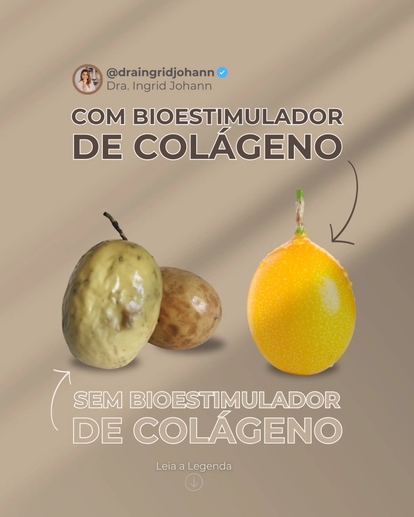 ✨ A diferença que o estímulo certo faz…
Enquanto o tempo naturalmente reduz o colágeno da pele, o bioestimulador entra como um grande aliado para devolver firmeza, sustentação e qualidade ✨
💭 Não é sobre “esticar” a pele…
é sobre estimular o seu próprio colágeno de dentro para fora.
Resultado?
💖 Pele mais firme
✨ Mais viço
👌 E um aspecto naturalmente rejuvenescido
📲 Agende sua avaliação e descubra como recuperar a firmeza da sua pele!
#bioestimulador #colageno #firmezadapele #rejuvenescimento #esteticaavancada