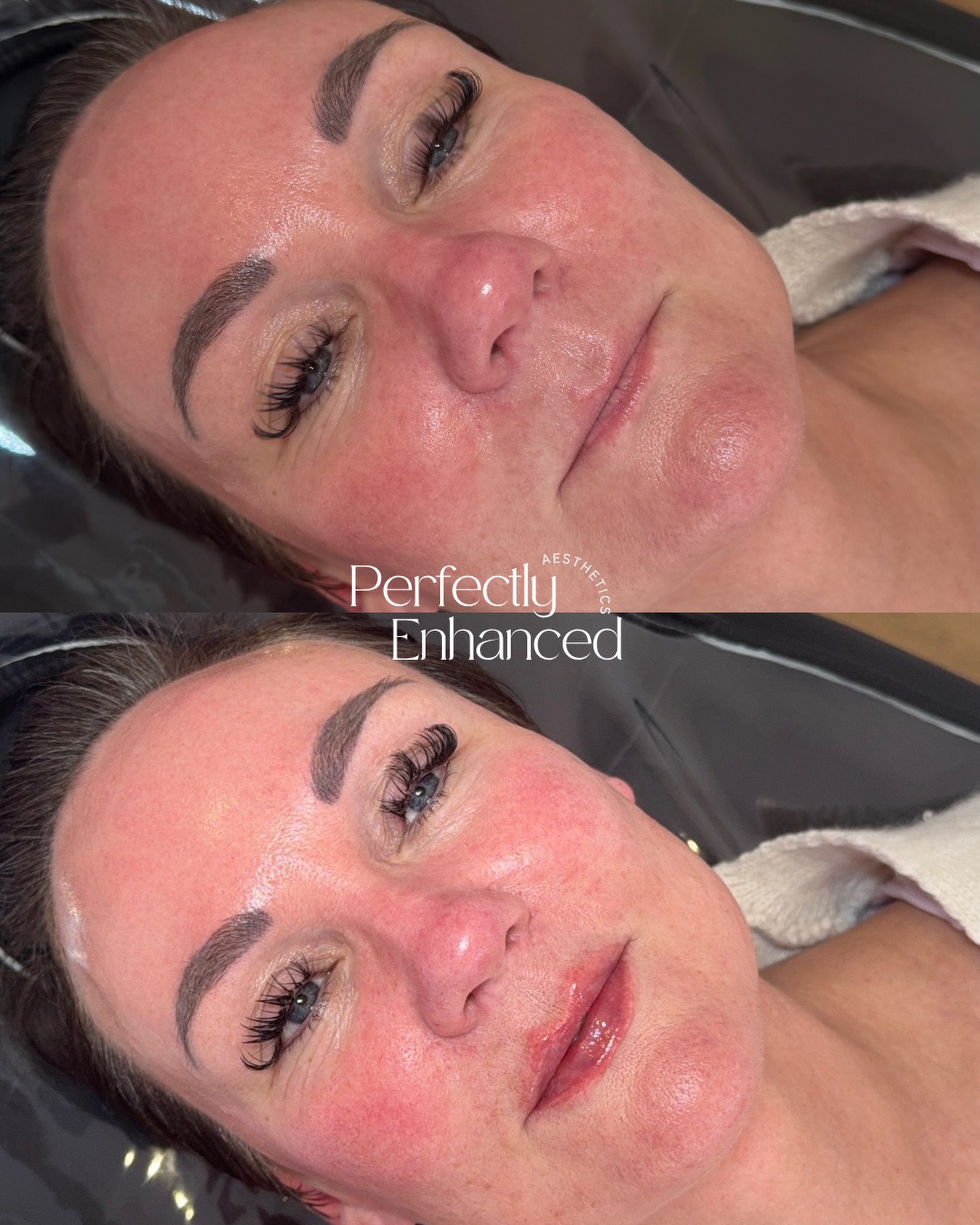 A gorgeous result from a dissolve & refill package💉
Sometimes it’s better to start from fresh - these results speak for themselves✨
If you book a dissolve & refill package, you can save £50 💸
💌BOOK VIA THE LINK IN BIO
#lipfillerdissolving #lipfiller #lipfillerresults #aestheticspractitioner #sunderlandaesthetics