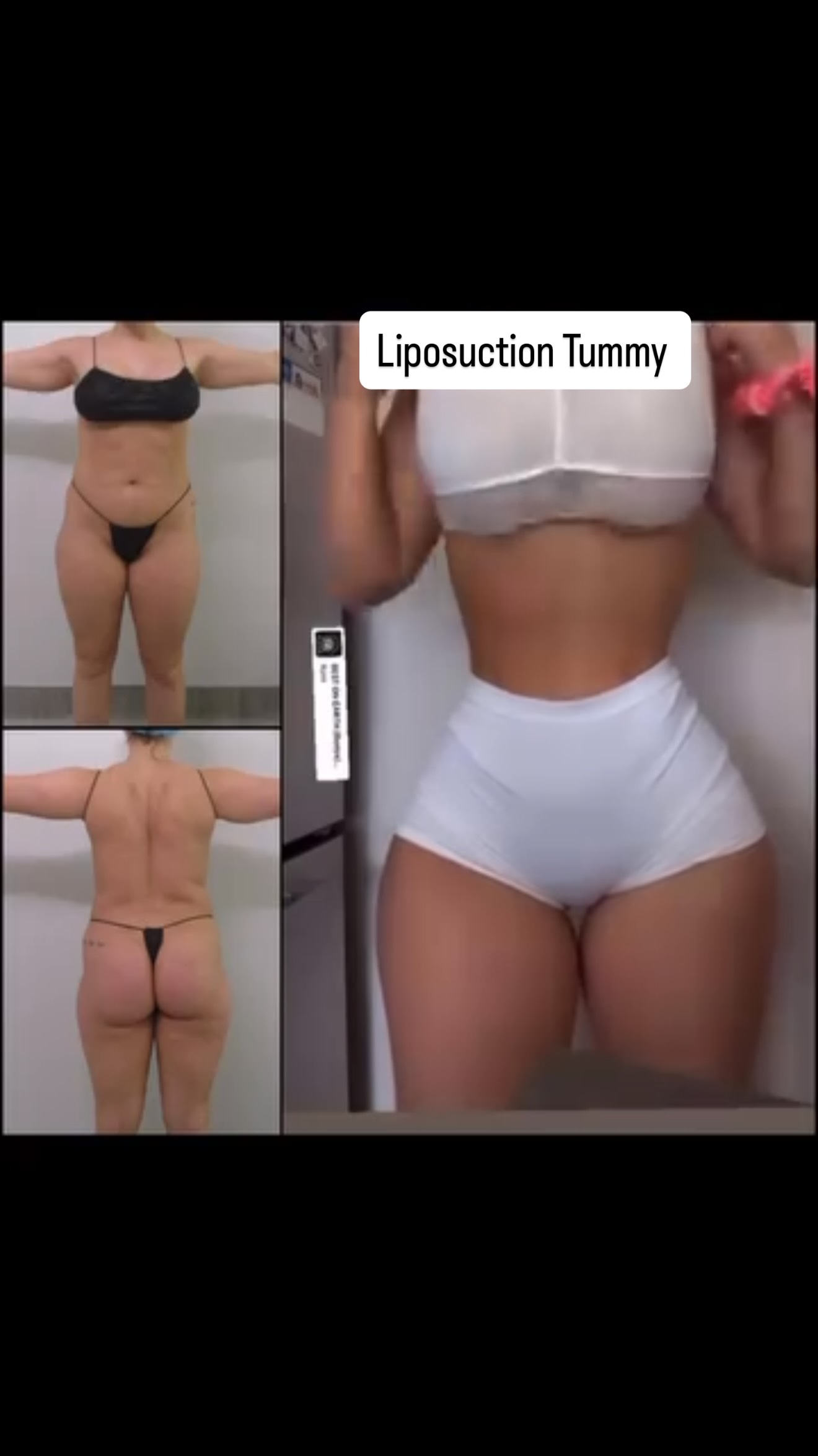 Liposuction Tummy Vietnam medical tourism
#fatremoval #rrbeautystudio #lipo #lipo360