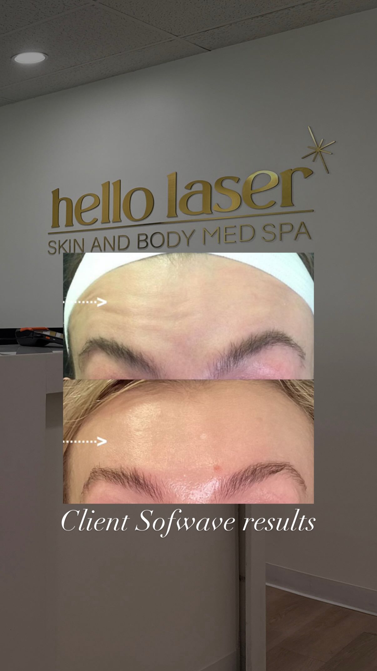 ✨ Skin tightening that actually keeps up with you ✨
Sofwave uses ultrasound tech to boost collagen and lift sagging skin. No needles, no downtime, just a little lunch-break magic. Smoother jawline, tighter neck, lifted brows. You walk in, you glow out. 💫
Book your Sofwave session in Scottsdale 🌵
#Sofwave# #SkinTightening #Gotlift #ScottsdaleMedspa CollagenBoost NoDowntimeGlow