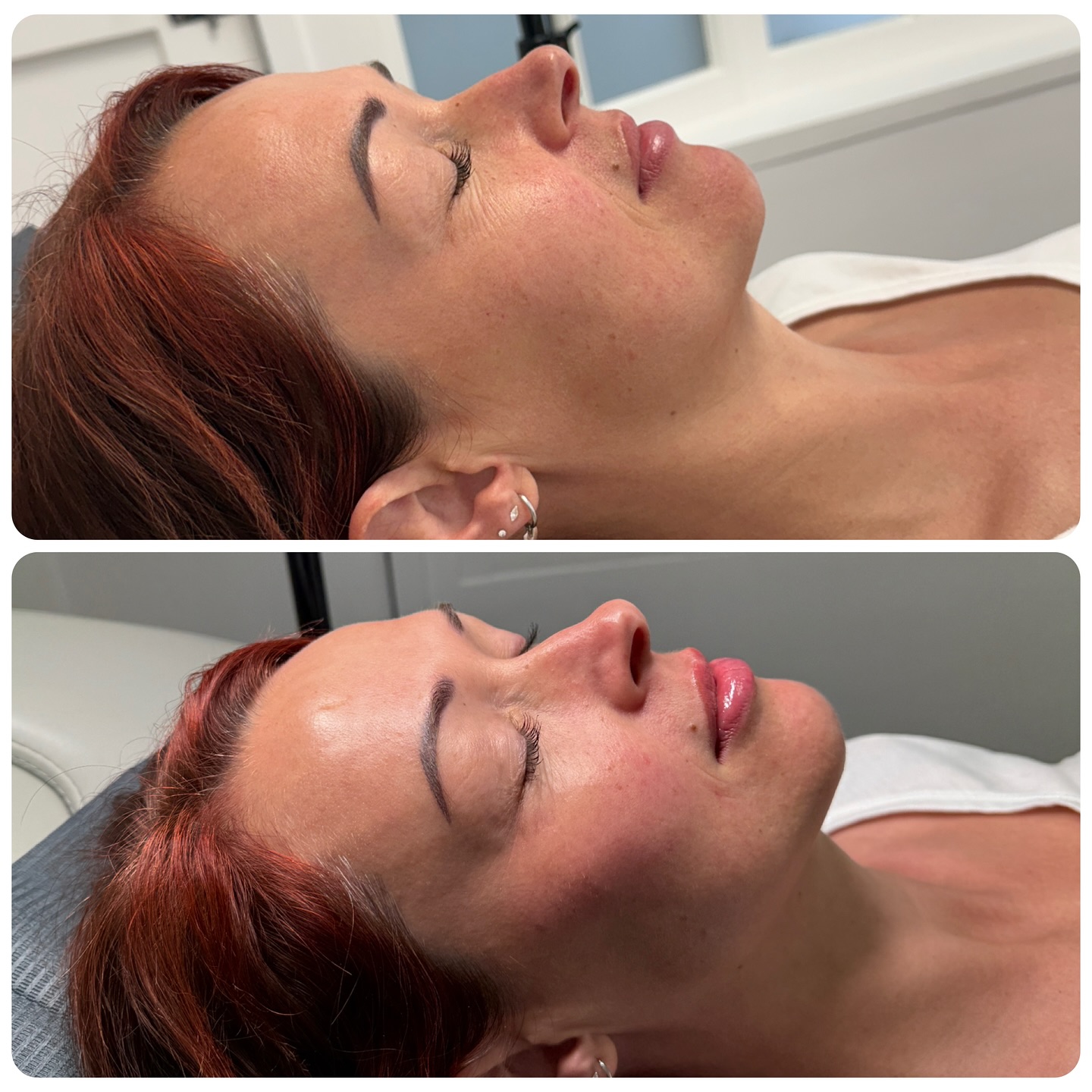 Contour restored. Folds softened. Lips perfected. ✨💉
⏩Swipe to see the before & after from the front
Here we used a 2ml ‘pick me up’ package to contour the cheeks, restore volume to the nasolabial folds (to soften the smile lines) plus a touch in the lips for hydration 🔥