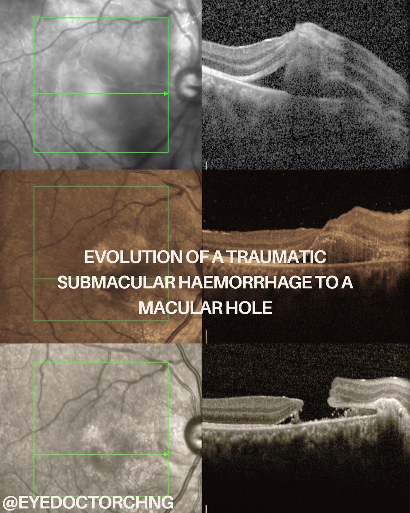 This is an OCT image of an evolution of a submacular haemorrhage following trauma in a young patient progressing to a macular hole.
Spontaneous closure in traumatic macular hole occurs in approximately 34–39%, particularly those with smaller minimum linear diameter (≤250 µm) and is more common in younger patients. 
Surgical closure rates of 80–96% have been reported across multiple case series using pars plans vitrectomy with internal limiting membrane peeling and gas tamponade. 
Timing matters because surgical intervention performed within 3 months of injury is associated with significantly better closure rates compared to delayed surgery.
#traumaticmacularhole #vitreoretinal #ophthalmology #eyetrauma #eyedoctorchng