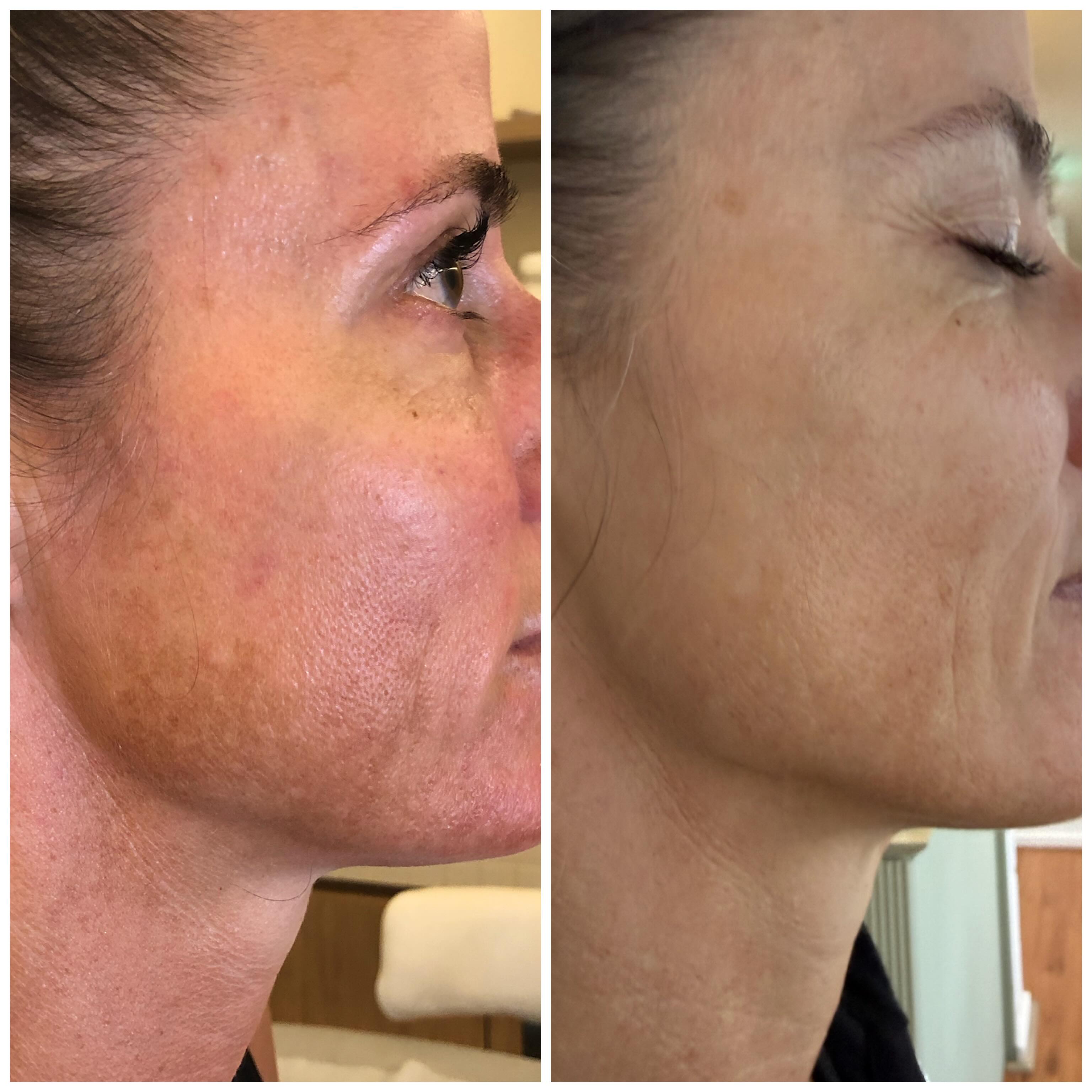 Pigmentation doesn’t disappear overnight!
This is what can happen when the skin is treated consistently, strategically and with the right plan.
No quick fixes.
No aggressive treatments.
Just patience, consistency and a personalised approach 🤍
This is exactly why I created my Kokosh Skin Programs because real skin transformation happens when every step builds on the last.
DM me if you’ve been struggling with stubborn pigmentation ❤️
#pigmentation #pigmentationtreatment #malasma #skin