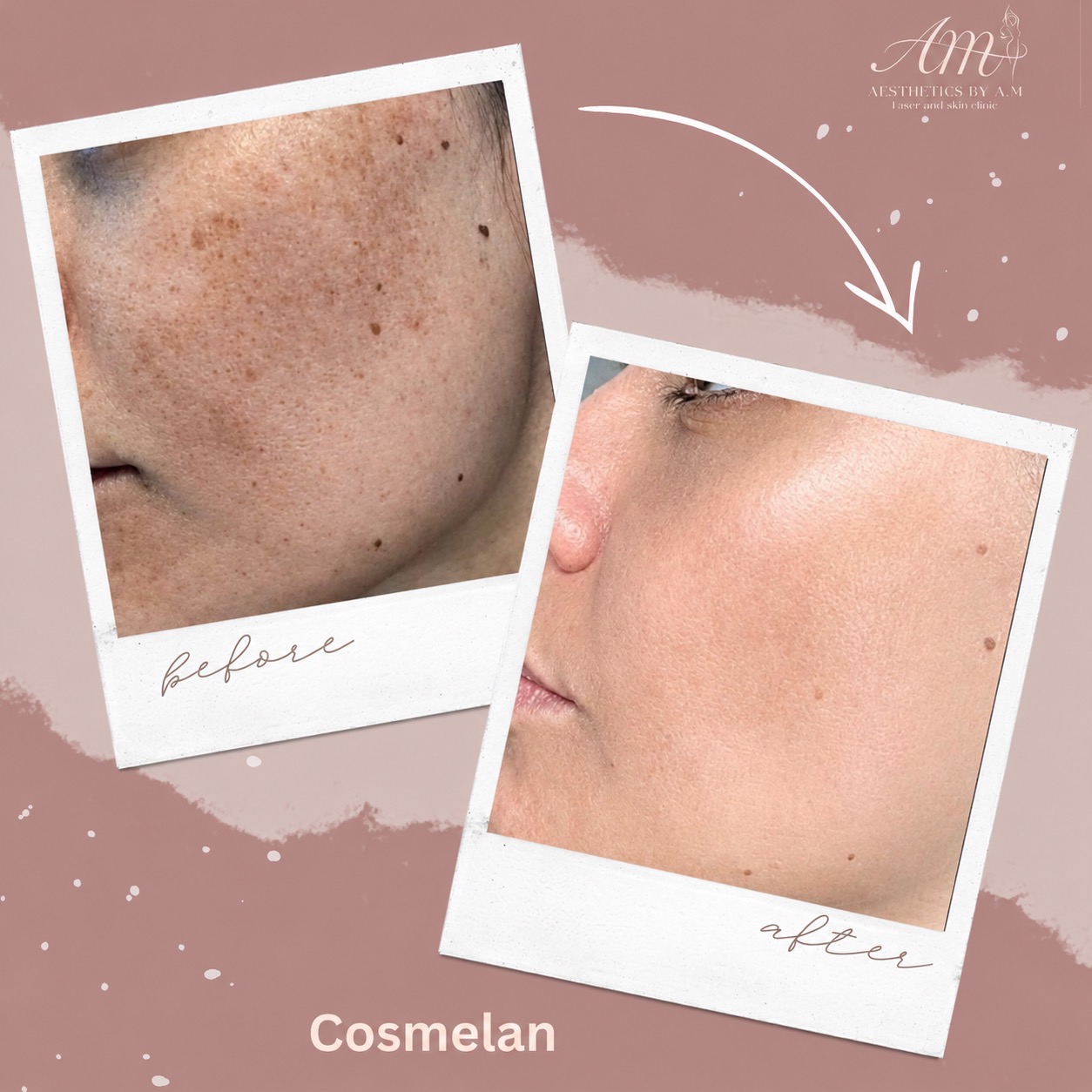 ✨ COSMELAN RESULTS ✨
Say goodbye to uneven skin tone, pigmentation and stubborn sun damage
Cosmelan is a professional depigmentation treatment designed to visibly reduce:
🤍 Melasma
🤍 Sun spots
🤍 Post-acne pigmentation
🤍 Uneven skin tone
These results show just how transformative the journey can be when the correct treatment plan and homecare are followed
Not only does Cosmelan target existing pigmentation, it also helps regulate melanin production to reduce future pigmentation concerns.
Ready to feel confident in your skin again?
DM us to book your consultation ✨
📍Aesthetics by A.M
#Cosmelan #PigmentationTreatment #Melasma #SkinClinic #GlowingSkin #BeforeAndAfter #MedicalGradeSkincare #OxfordshireAesthetics #SkinRejuvenation
