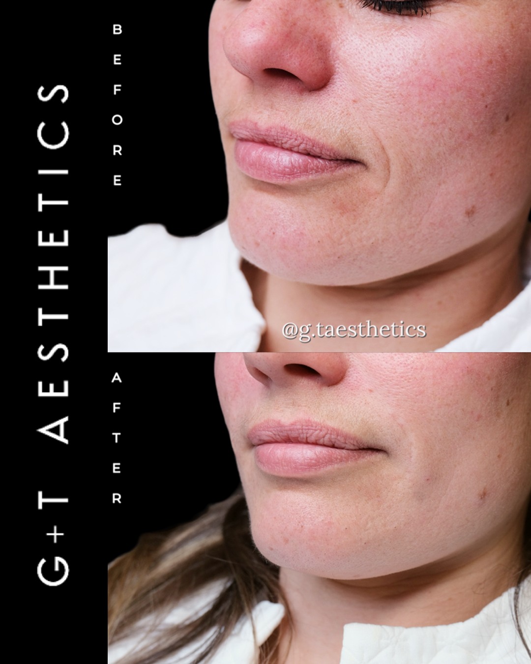 Targeted treatment to soften deeper lines and restore facial harmony. Dermal fillers for marionette lines can help create a smoother, more rejuvenated lower face appearance without compromising natural expression.
📲Enquire or visit www.gtaesthetics.co.uk for more info.
#MarionetteLines #DermalFillers #FacialRejuvenation #BeforeAndAfter #NaturalEnhancement #GTAesthetics