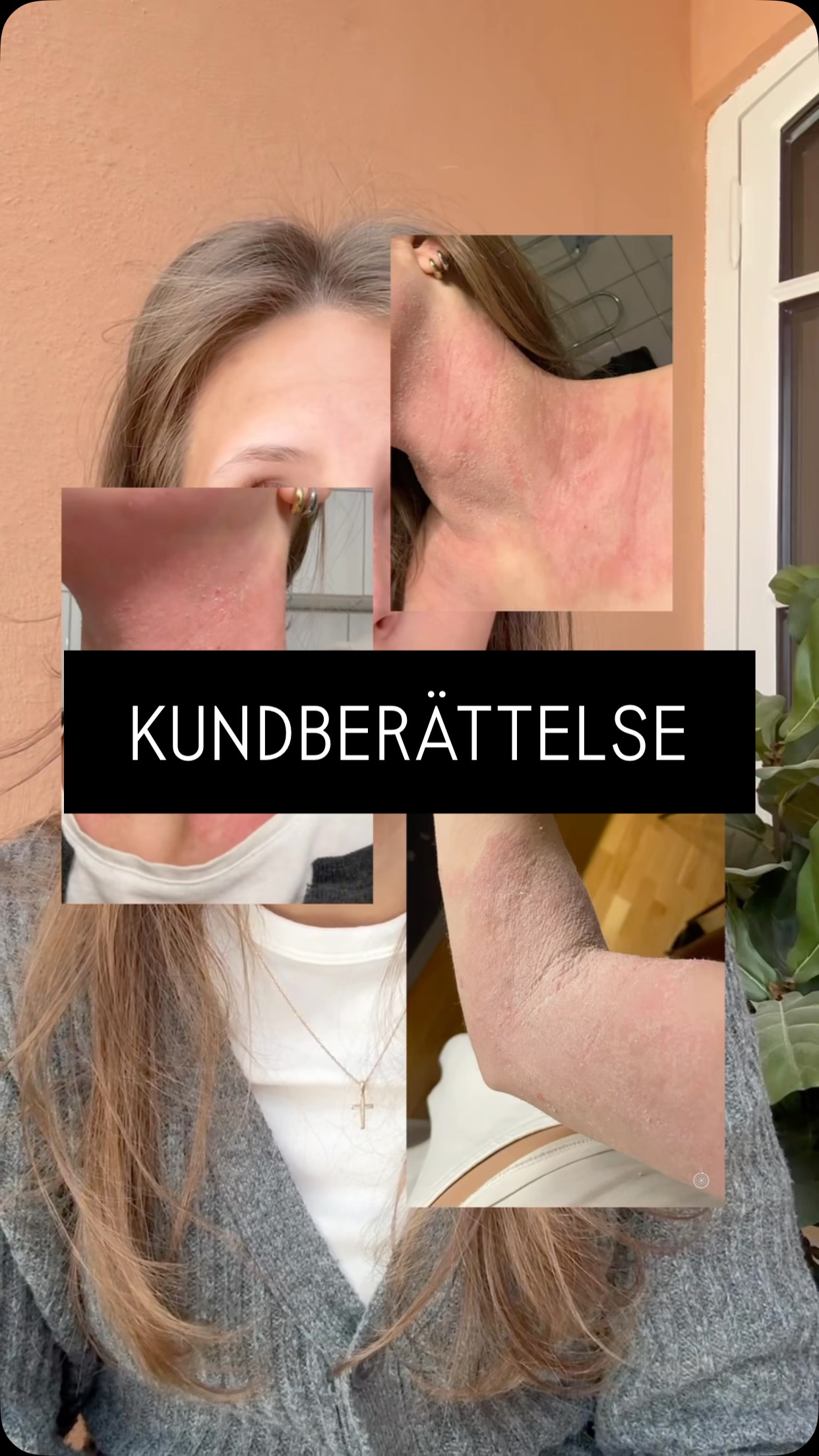 TSW är så mycket mer än bara “dålig hud”.
För många påverkar det sömnen, självkänslan, den mentala hälsan och hela vardagen.
Att få se sådana här stunder påminner oss om varför vi gör det vi gör. ❤️
#TSW #TopicalSteroidWithdrawal #CAPbehandling #kortison