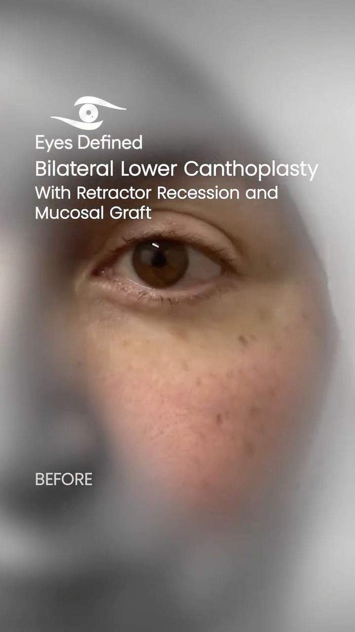 This patient developed lower eyelid retraction and difficulty closing the eyes fully following bilateral lower blepharoplasty. Revision surgery was performed using bilateral canthoplasty and mucosal grafting to help restore eyelid position, improve comfort and achieve a more natural appearance.
Revision eyelid surgery is often significantly more complex than primary surgery and requires careful assessment, realistic expectations and a strong focus on both function and appearance.
#lowerblepharoplasty #blepharoplasty #revisionblepharoplasty #oculoplastics #eyelidsurgery #lowerlidretraction #canthoplasty #eyelidspecialist #londonsurgeon #oculoplasticsurgeon #facialplastics #eyelidrevision #harleystreet #beforeandafter #eyesdefined