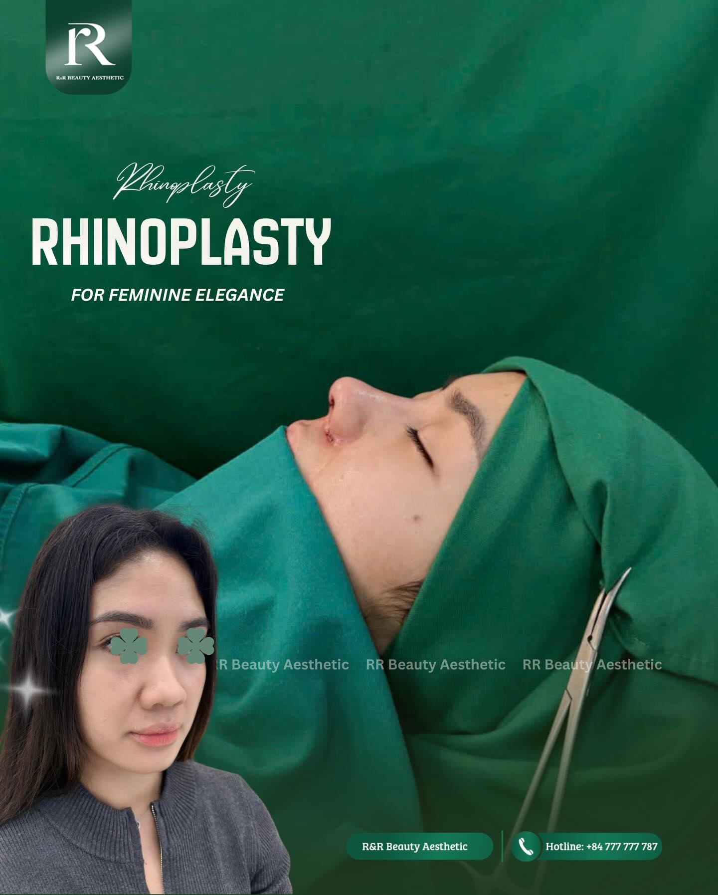✨ BABY DOLL RHINOPLASTY ✨
A beautifully balanced nose can transform the harmony of the entire face.
✔ Soft and feminine profile
✔ Refined nose tip definition
✔ Improved facial harmony and balance
✔ Customized design based on facial proportions
✔ International-standard surgical environment
✔ Personalized 1:1 consultation and aftercare
Vietnam Clinic
R&R Beauty Aesthetic / R&R Beauty Clinic
📍 10A Truc Duong, An Khanh Ward, Ho Chi Minh City, Vietnam
Singapore Studio
R&R Beauty Studio
📍 416 Ang Mo Kio Ave 10, #01-985, Singapore 560416
.
.
#babydollnose #rhinoplasty #nosejob #plasticsurgery rrbeautyaesthetics aestheticclinic medicalbeauty facialharmony beautyjourney confidence
baby doll rhinoplasty natural nose enhancement facial harmony premium aesthetic clinic international beauty surgery feminine nose profile customized rhinoplasty natural looking results