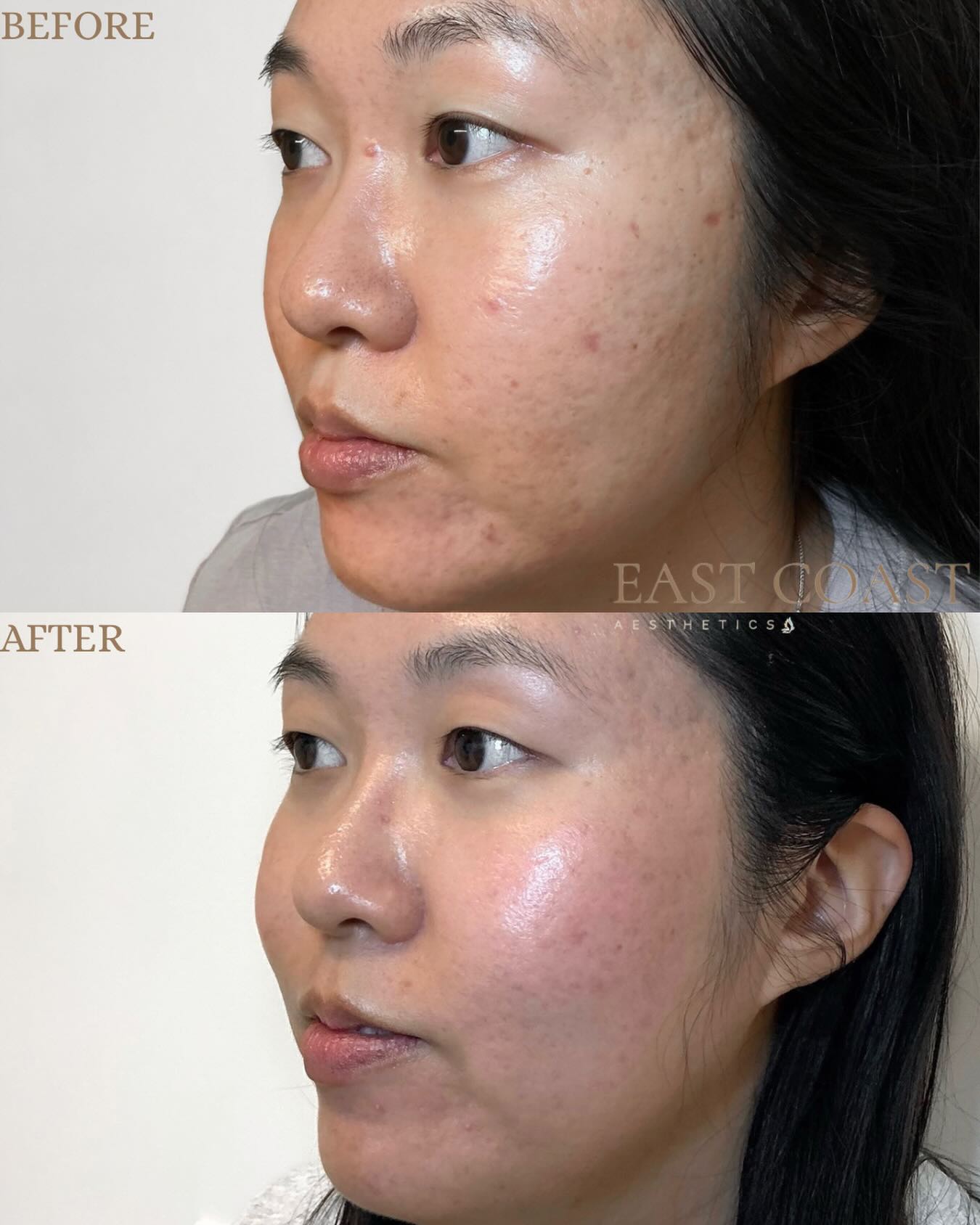 This patient’s results were achieved through a combination of VYBE RF Microneedling, CoolPeel, and Acne BBL Heroic treatments to target acne and improve overall skin texture and appearance ✨
#eastcoastaesthetics #medspa #microneedling #bblheroic #skincare