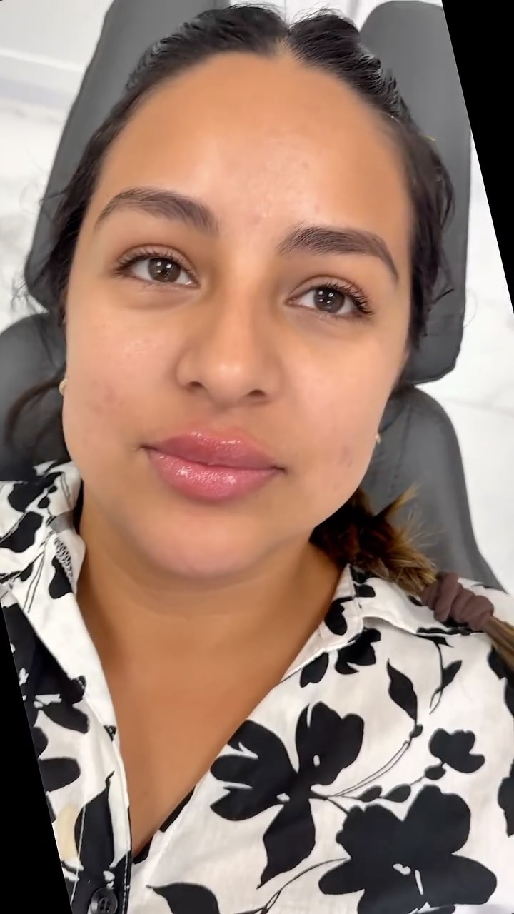 Soft. Plump. Beautiful. ✨ Lip fillers can help restore lost volume, define your lip borders, and create the perfect balanced look.
Call or text today to book your appointment!
☎️ 239-448-3383
📩 chris.jewell@jewellmedicalspa.com
🌐 www.jewellmedicalspa.com | www.mrinjectable.com
📍 1044 Castello Drive, Ste 213 Naples Florida 34103
💳 We Accept Care Credit!
*
*
*
#lipfiller #lipfillers #lipaugmentation #lipplump #lipinjection #lipenhancement
#lipcontouring #restylanelips #injectables #dermalfillers #cosmeticinjectables #aesthetics #beauty #restylane #restylaneusa #naplesbeauty #naplesinjector #medspa #dolllips #lippies #bestaestheticinjectors #beforeandafter