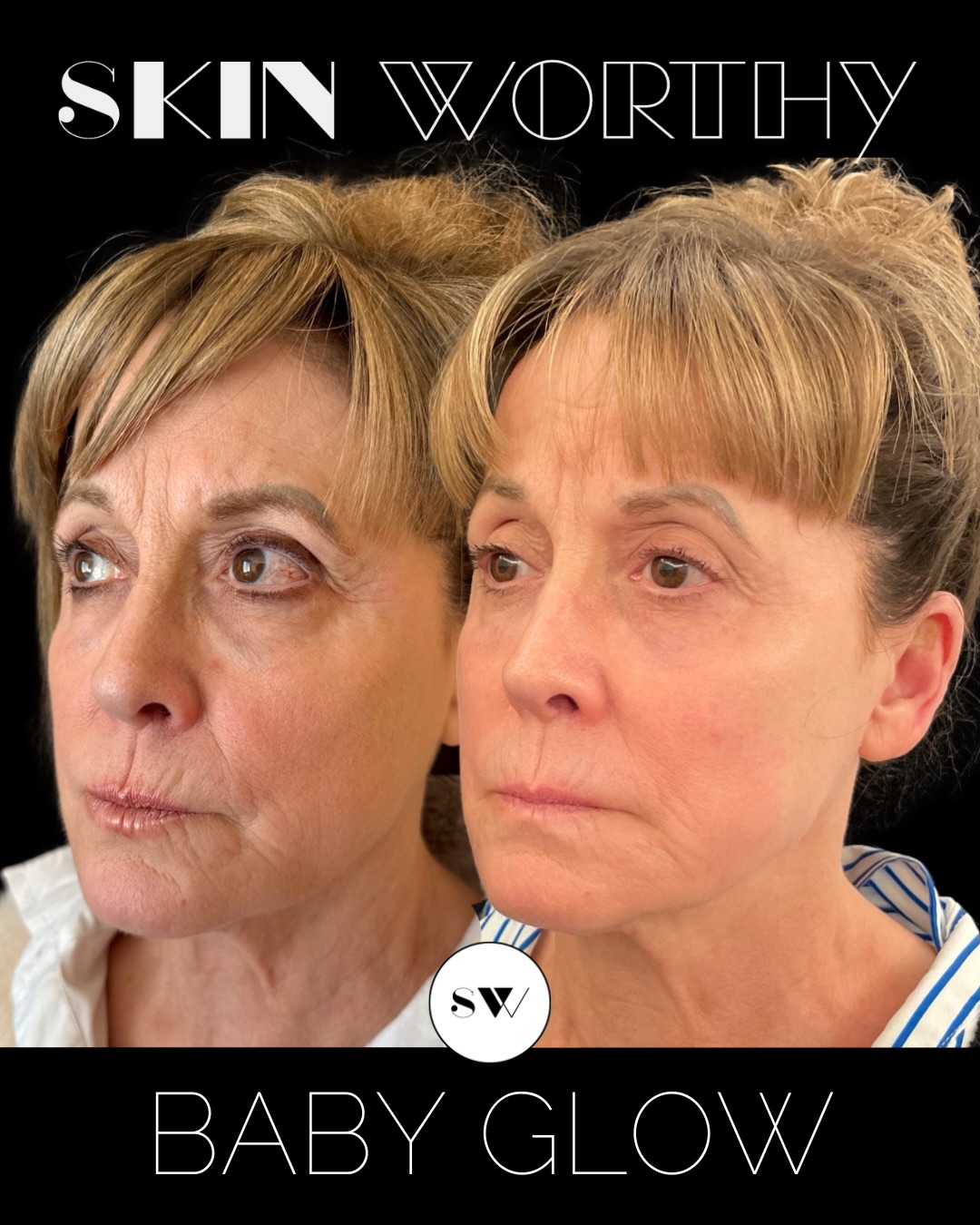 Glow you can see, hydration you can feel ✨
This before & after shows what’s possible with 2 Baby Glow treatments, done 2 weeks apart designed to deeply hydrate, smooth, and illuminate the skin from within for that fresh, dewy, “lit-from-within” glow.
Baby Glow uses Redensity 1 with an 8-point strategic injection technique to create natural-looking highlights in all the right places enhancing radiance, skin quality, and overall luminosity without adding volume or changing facial features.
For a limited time: 2 Baby Glow treatments for $999
That’s a savings of $300.
Ready for your glow-up?
Book your Baby Glow consultation today.