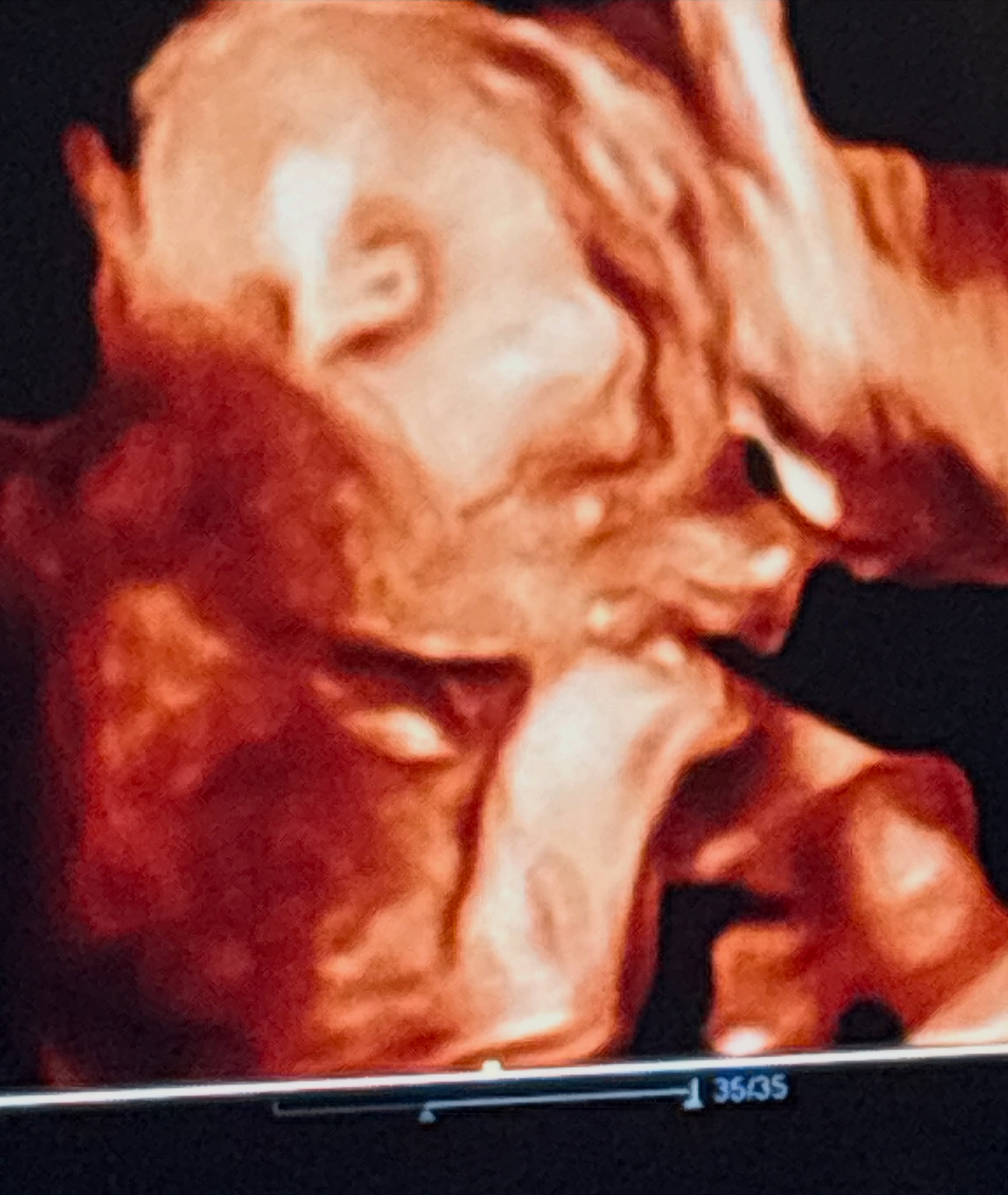 Question for the Day:
“Will baby open their eyes?”👀
Weeks 8 to 26: A baby’s eyelids form early on but remain tightly fused shut. This protects the delicate, developing retina and structures of the eye.
Weeks 26 to 28: The eyelids naturally begin to separate. By this point in the third trimester, babies start opening and closing their eyes, blinking, and practicing looking around.
Even though it is dark inside the womb, it isn’t pitch black. Your abdominal wall transmits light, and a baby can actually perceive bright light sources from the outside world.
If they open their eyes during a scan, they might be:
👁️Blinking or squinting: Reacting to the pressure of the ultrasound transducer probe or acoustic waves.
💤REM Sleep: Just like adults, babies experience Rapid Eye Movement (REM) sleep in the womb, where their eyes dart beneath or just as their lids part.
🔎Exploring: Simply waking up for a brief period to practice motor reflexes.
Because babies spend about 90-95% of their time asleep in the womb, catching them with their eyes wide open during a quick 4D scan appointment is mostly a matter of perfect, lucky timing!📸
#4DScan #GenderReveal #BabyScan #BabyNews #BabyLife