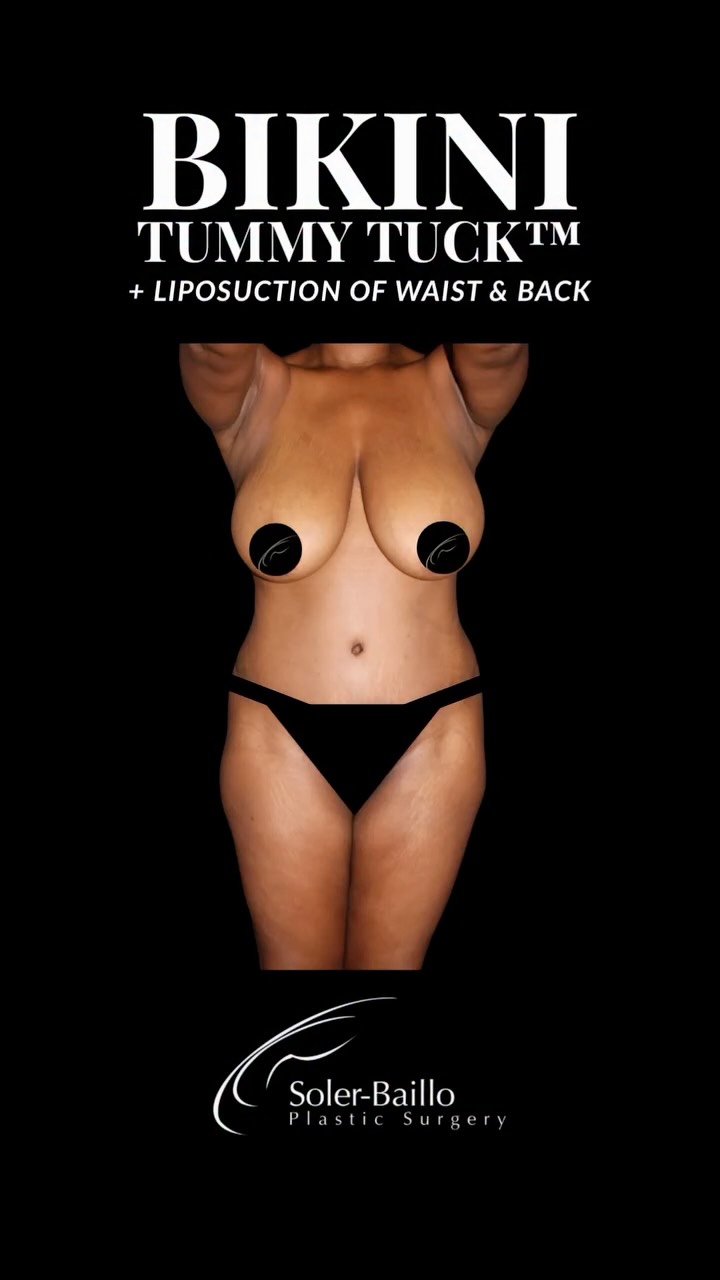 Bikini line snatched. Confidence restored. ✨
Dr. Soler-Baillo’s signature Bikini Tummy Tuck is designed with a strategically placed low scar that stays hidden beneath most swimwear and underwear, while tailored liposuction enhances the waistline for a smoother, more sculpted silhouette. Finished results that still look like you — just more confident.
Whether you’re looking to retire your body after pregnancy, weight loss, or simply want to feel more comfortable in your clothes again, this procedure is designed with both aesthetics and recovery in mind.
Ready to learn if you’re a candidate?
Schedule your consultation today and start your transformation. ✨
#BikiniTummyTuck #drsolerbaillo #whenresultsmatter #plasticsurgerymiami #liposuction