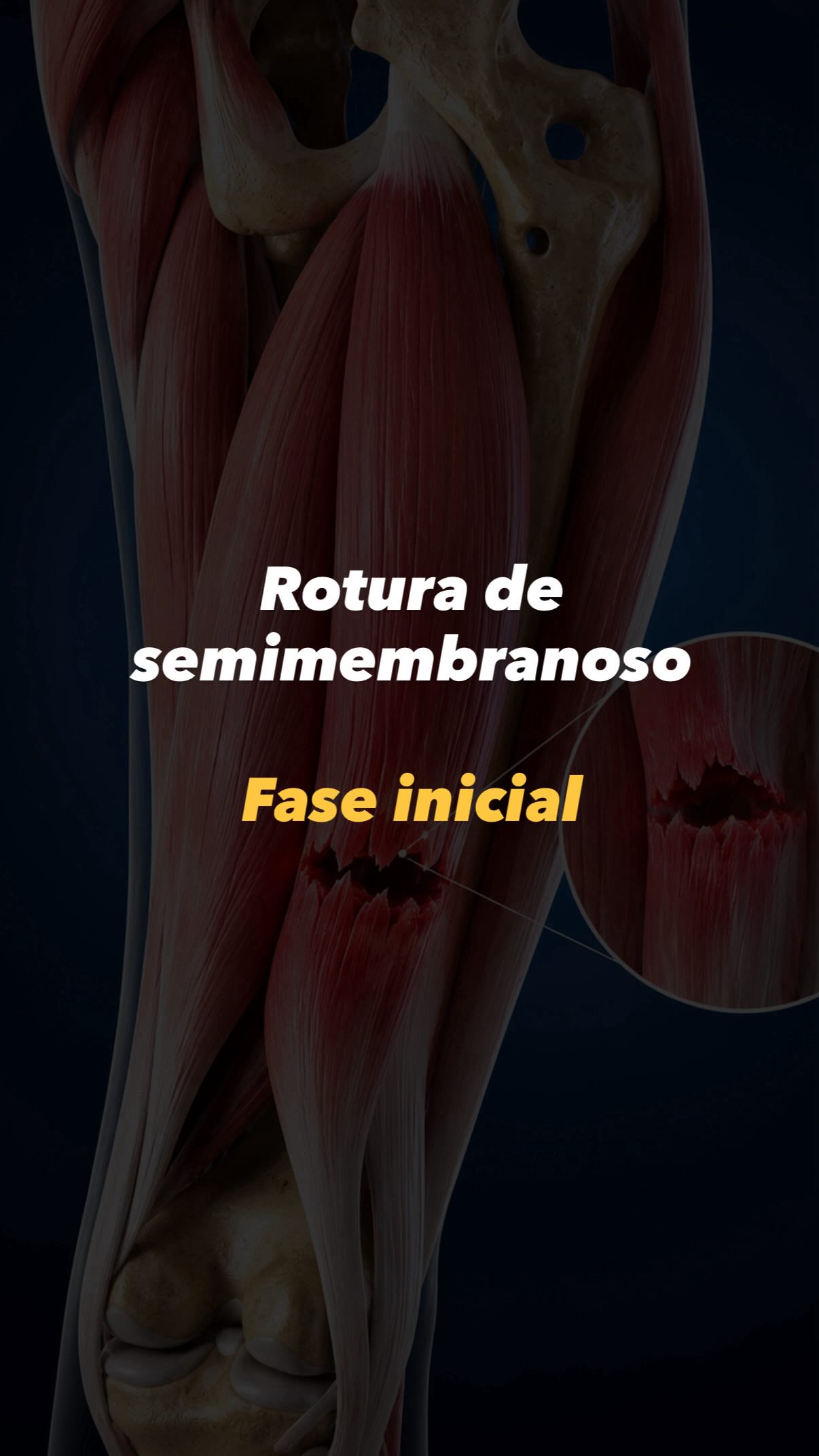 💔 Tratamiento de rotura muscular 💪🏻
Os mostramos el trabajo de las primeras sesiones de una rotura de la musculatura isquiotobial en una jugadora de hockey 🏑
En esta fase inicial buscamos controlar la inflamación y el dolor, reposo relativo, deambulación con muletas y descarga del miembro afecto. Todo ello será necesario para generar una cicatriz, que posteriormente sea funcional y no genere adherencias ni restricciones.
Combinamos microcorrientes, radiofrecuencia y ejercicio terapéutico mediante trabajo isométrico y activación concéntrica progresiva para favorecer la reparación tisular y preservar la función desde el inicio.
🤩 Seguimos con el proceso 🙌🏼
#fisioterapiadeportiva #hamstringrehab #madrid