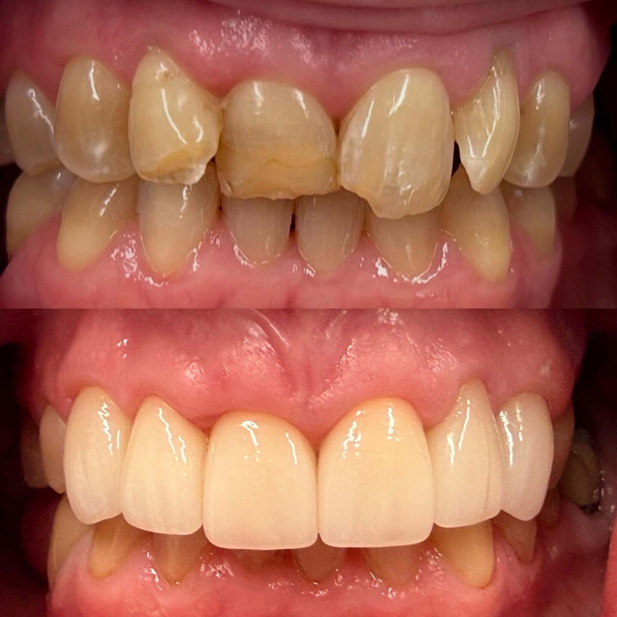 This smile is a beautiful look! 😁 🙌🏻 #lohrfamilydentistry #cosmeticdentistry #siouxcitycosmeticdentistry #drlohrdds #lisaisbeautifulinsideandout