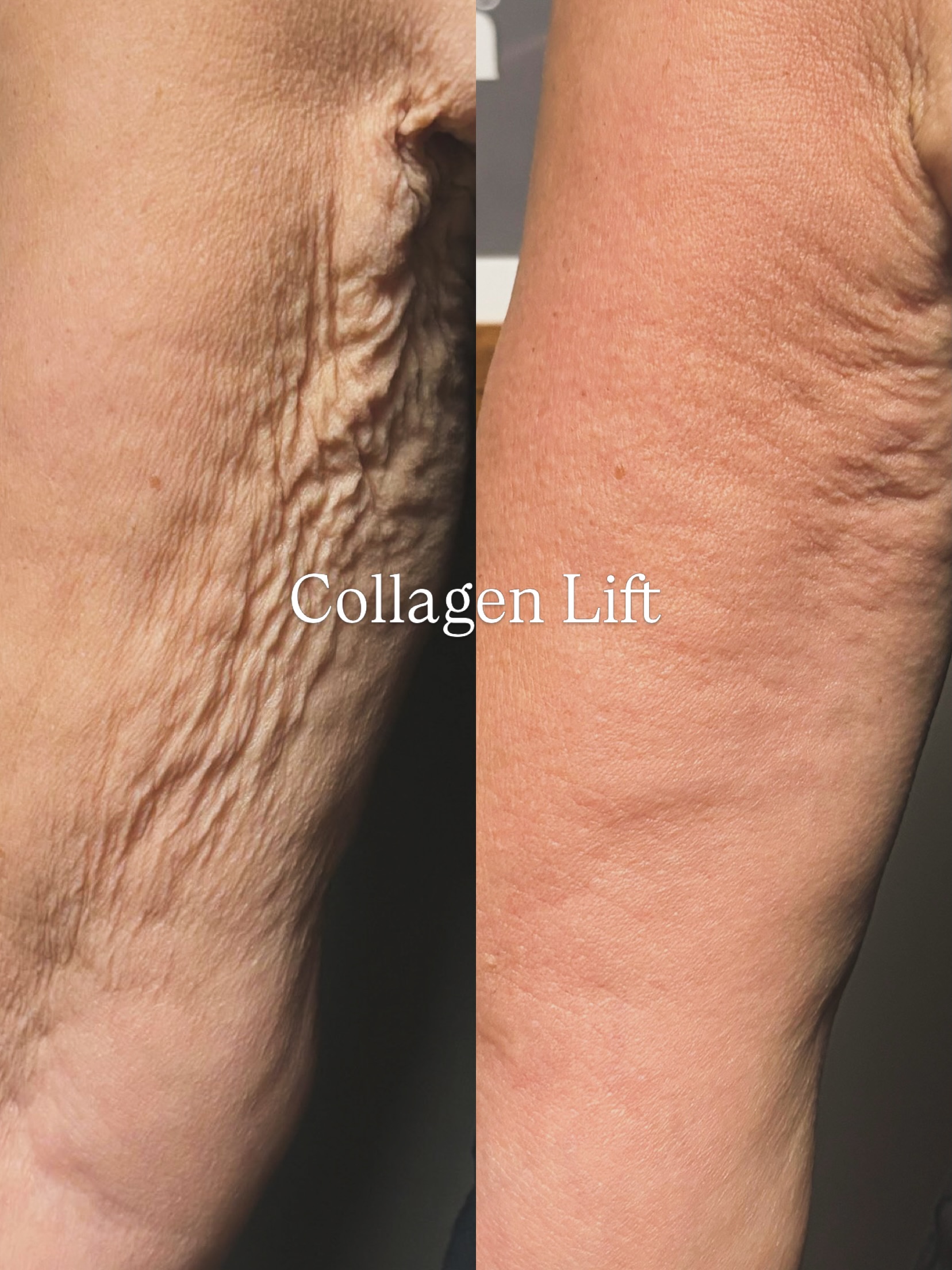 ✨ This transformation is simply too incredible not to share again! ✨
Just look at these amazing before and after results from our Collagen Lift treatment on the arms. 🤍
A non-invasive treatment designed to help improve skin firmness, texture and overall appearance, leaving skin looking smoother and more rejuvenated.
With summer fast approaching, now is the perfect time to start your treatment journey and feel confident showing a little more skin. ☀️
Ready to discover what Collagen Lift could do for you?
📩 Get in touch to book your consultation.
#CollagenLift #BeforeAndAfter #SkinTightening #SummerReady #BodyConfidence SerenitySalons