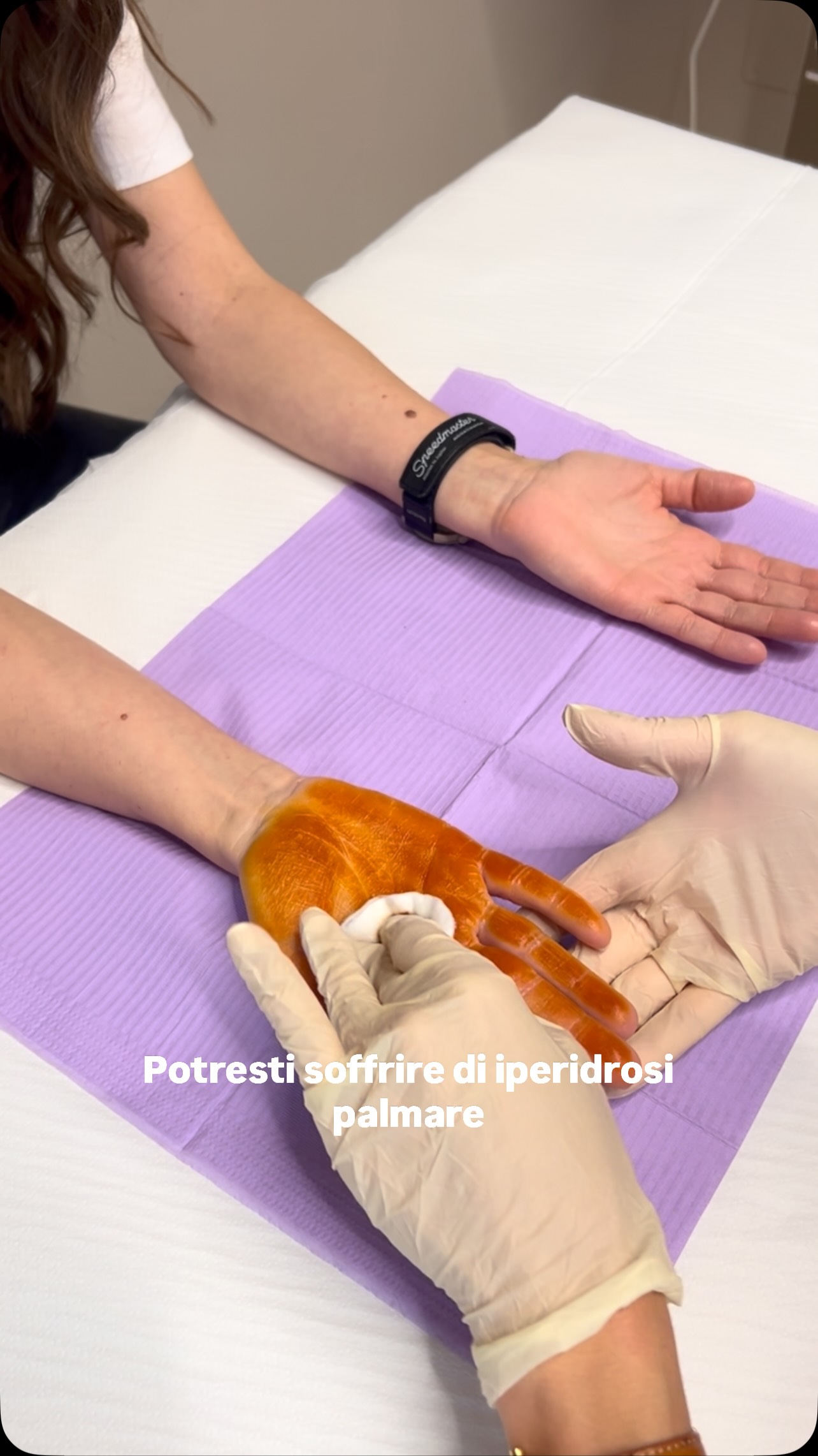 L’iperidrosi palmare è una condizione caratterizzata da un’eccessiva sudorazione delle mani. Può interferire con semplici attività quotidiane come scrivere, usare il telefono o stringere una mano.
Tra i trattamenti più efficaci c’è la tossina botulinica, che riduce temporaneamente l’attività delle ghiandole sudoripare, migliorando significativamente la qualità di vita.
Il trattamento è ambulatoriale, rapido e i risultati durano in media 4-6 mesi.
Se il sudore delle mani ti crea disagio, una valutazione dermatologica può aiutarti a trovare la soluzione più adatta
#iperidrosi #tossinabotulinica