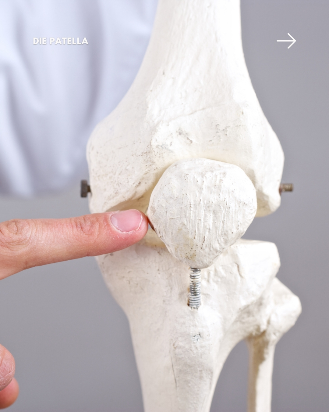 🦴 Die Patella – klein, aber entscheidend für jede Bewegung.
Heute gibt es einen kleinen Ausflug in die Anatomie unseres Körpers:
Die Kniescheibe (Patella) ist nicht nur ein Knochen an der Vorderseite des Knies, sondern das größte sogenannte Sesambein unseres Körpers. Das bedeutet: Sie ist direkt in die Sehne des großen Oberschenkelmuskels (Musculus quadriceps femoris) eingebettet.
Ihre Aufgabe? Sie wirkt wie ein natürlicher Verstärker: Bei der Kniestreckung überträgt die Patella die Kraft vom Oberschenkel auf den Unterschenkel und erhöht dabei die Hebelwirkung der Streckmuskulatur. Dadurch kann die Kraft der Muskeln nahezu verdoppelt werden.
💡 Die Patella macht alltägliche Bewegungen wie Gehen, Treppensteigen, Aufstehen oder Laufen deutlich effizienter.
Ein kleines Knochenstück mit großer Wirkung.