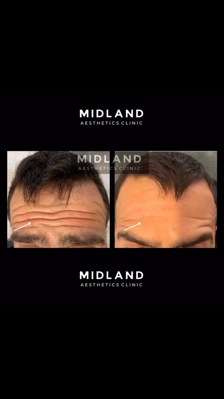 A powerful anti-wrinkle treatment transformation for this gentleman.
He presented with significant static and dynamic forehead lines, including deep, established folds that had developed over time. Our treatment approach focused on carefully relaxing the frontalis muscle with anti-wrinkle injections to reduce excessive movement while maintaining a natural appearance.
To achieve optimal facial balance, we also treated the crow’s feet and frown area (procerus complex), creating a harmonious and refreshed result across the upper face.
The outcome? A noticeably smoother forehead, significant softening of deep folds, and a rejuvenated appearance that helps restore confidence without looking overdone.
Subtle. Natural. Effective.
#AntiWrinkleTreatment #AestheticMedicine #NaturalResults #FacialRejuvenation #ConfidenceBoost