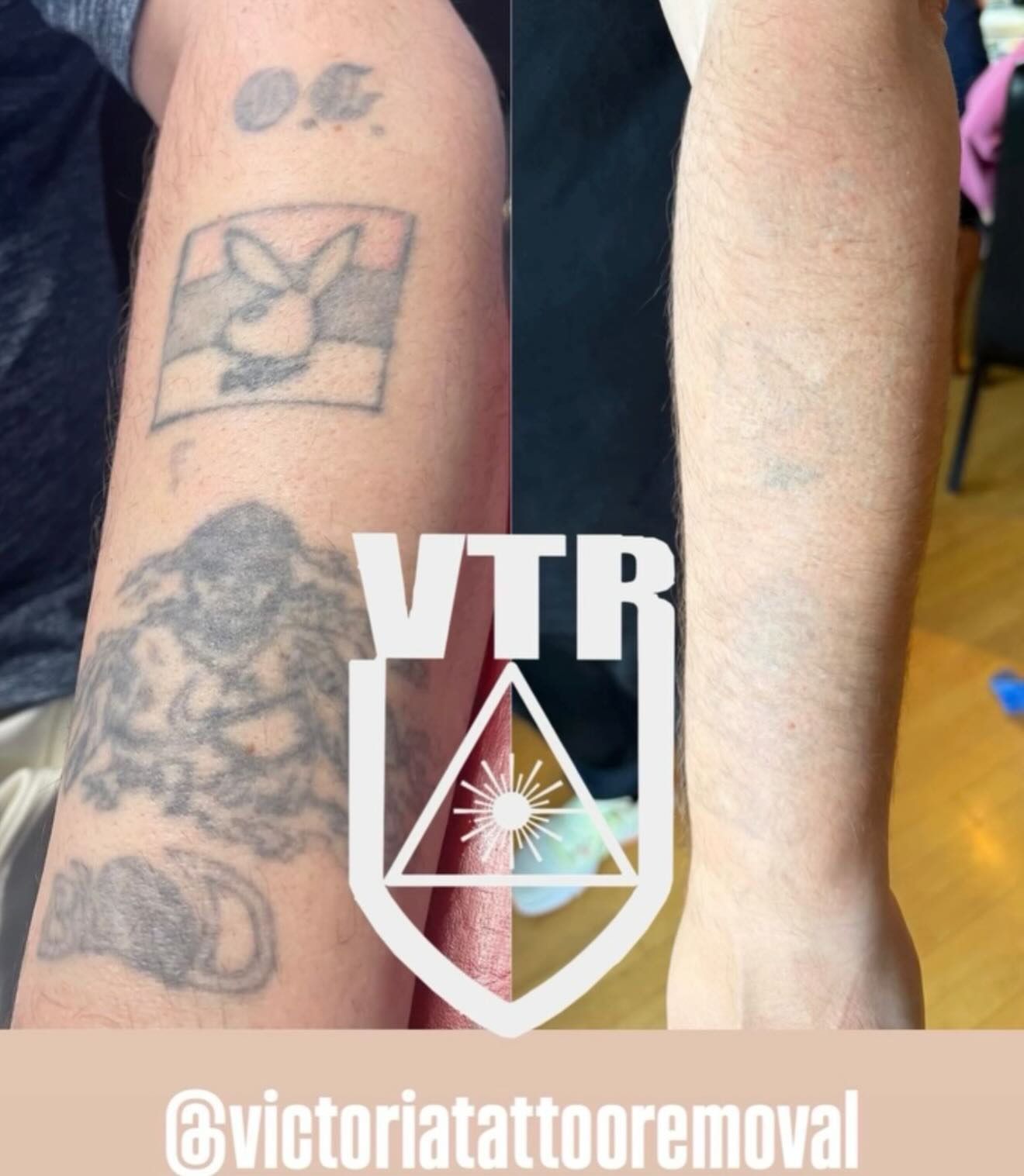 We are Tattoo and Permanent make up Removal Specialist’s! This is what we do! Keeping the integrity of your skin is so important to us- We love working with your tattoo artist or brow artist so you can get the tattoo or brows of your dreams !