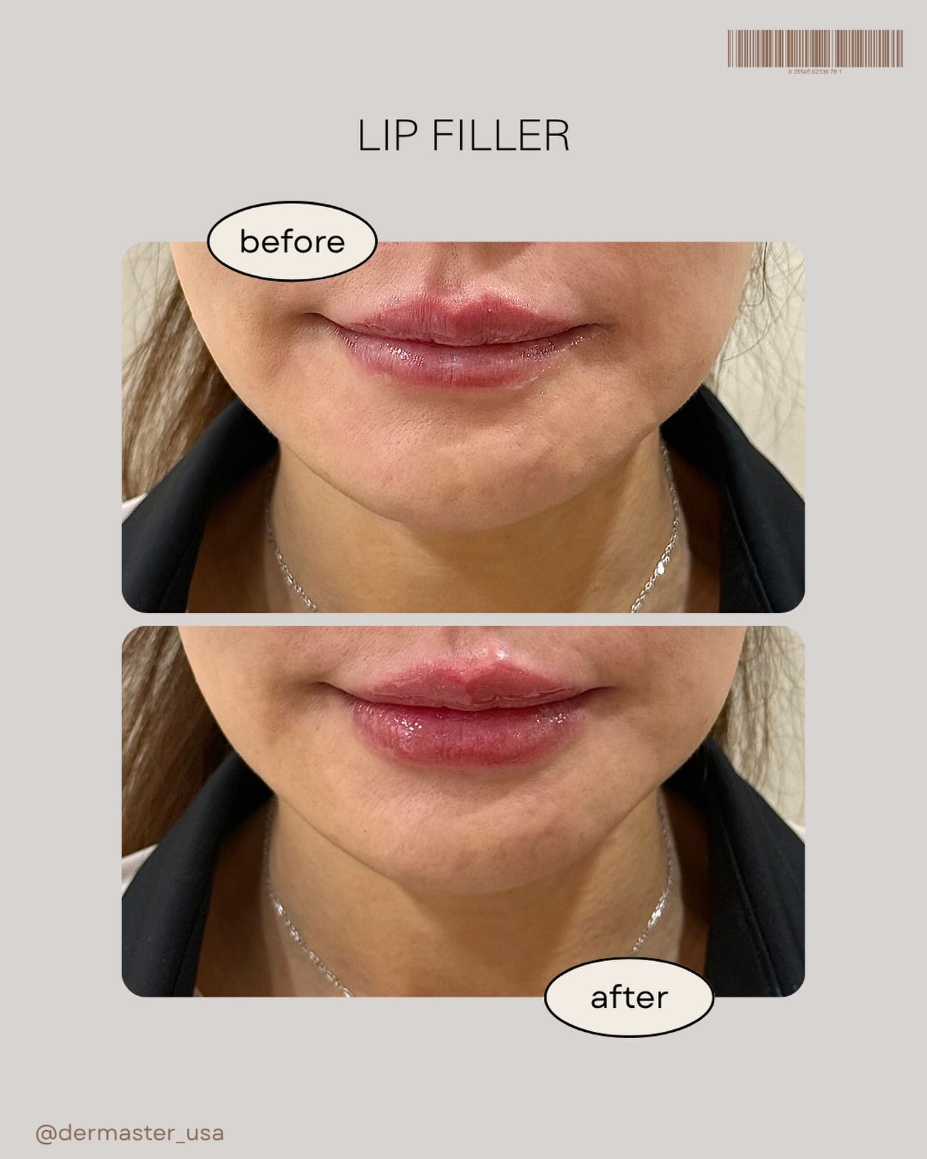 Enhance your natural beauty with lip filler π
Subtle volume, defined shape, and hydrated-looking lipsβ
all tailored to complement your facial features.
Whether you want a soft, natural look or a more defined pout,
we customize every treatment just for you.
β¨ Instant results
β¨ Minimal downtime
β¨ Natural-looking enhancement
Book your consultation today and let your lips do the talking π«
π 3000 W Olympic Blvd #305, Los Angeles
π 213-814-8410
#lip #filler #lipfiller #lamedspa #dermaster