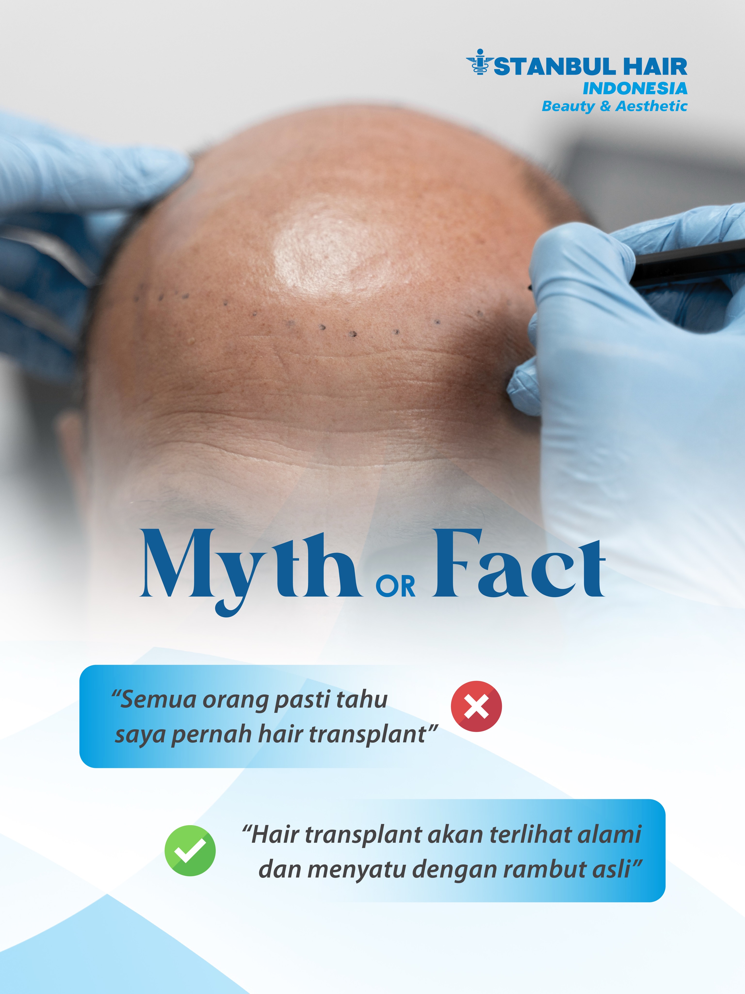Banyak orang masih mengira hasil hair transplant akan terlihat tidak alami atau mudah dikenali. Faktanya, dengan desain hairline yang tepat, penempatan graft yang presisi, dan perencanaan yang baik, hasil hair transplant dapat menyatu dengan rambut asli sehingga tampak natural.
Justru, hair transplant yang berhasil adalah ketika orang lain melihat Anda tampak lebih percaya diri tanpa menyadari bahwa Anda pernah menjalani prosedur hair transplant.
Ini adalah seri pertama dari #MythVsFactIHI. Nantikan pembahasan mitos dan fakta lainnya seputar hair transplant bersama Istanbul Hair Indonesia.
📍 Istanbul Hair Indonesia
✨ Natural Hairline • Natural Results
#IstanbulHairIndonesia #HairTransplant #HairTransplantIndonesia #FUEHairTransplant NaturalHairline