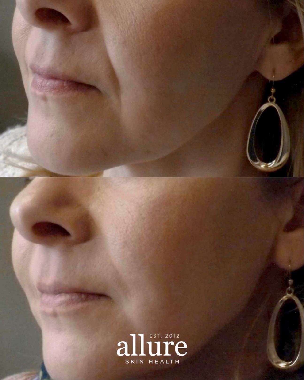 A little support can make such a beautiful difference!! 🤎✨
These results are from 2 syringes of Radiesse to soften smile lines/nasolabial folds while restoring support through the midface.
One of the reasons we love Radiesse is because it not only adds volume, but also stimulates your natural collagen production over time! 🙌
Right now we’re offering:
2 syringes of Radiesse for $1199
(normally $1600)
Offer expires July 15th, 2026.
📲 Call or text 608.772.0069 to book!
Consultations are always free. 🤎
#allureskinhealth #radiesse #nasolabialfolds
