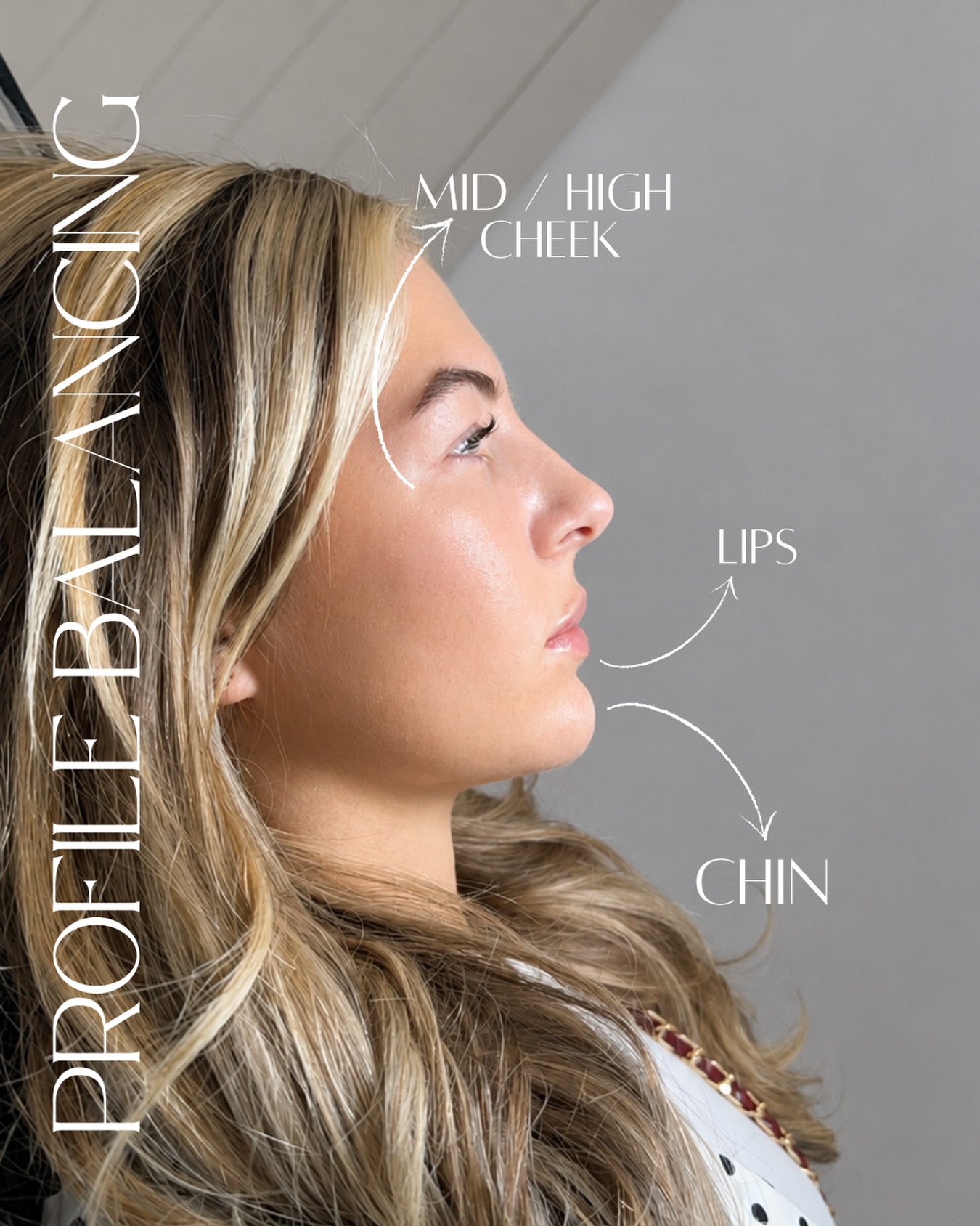 Another stunning result from our profile balancing package✨
Completely suited to your face - specific placement of facial filler to enhance your profile, ready for summer ☀️
Lucy had new fresh filler into the lips after dissolving, mid / high cheek filler & chin filler🫶🏼
#profilebalancing #facialfiller #sunderlandaesthetics #aestheticspractitioner