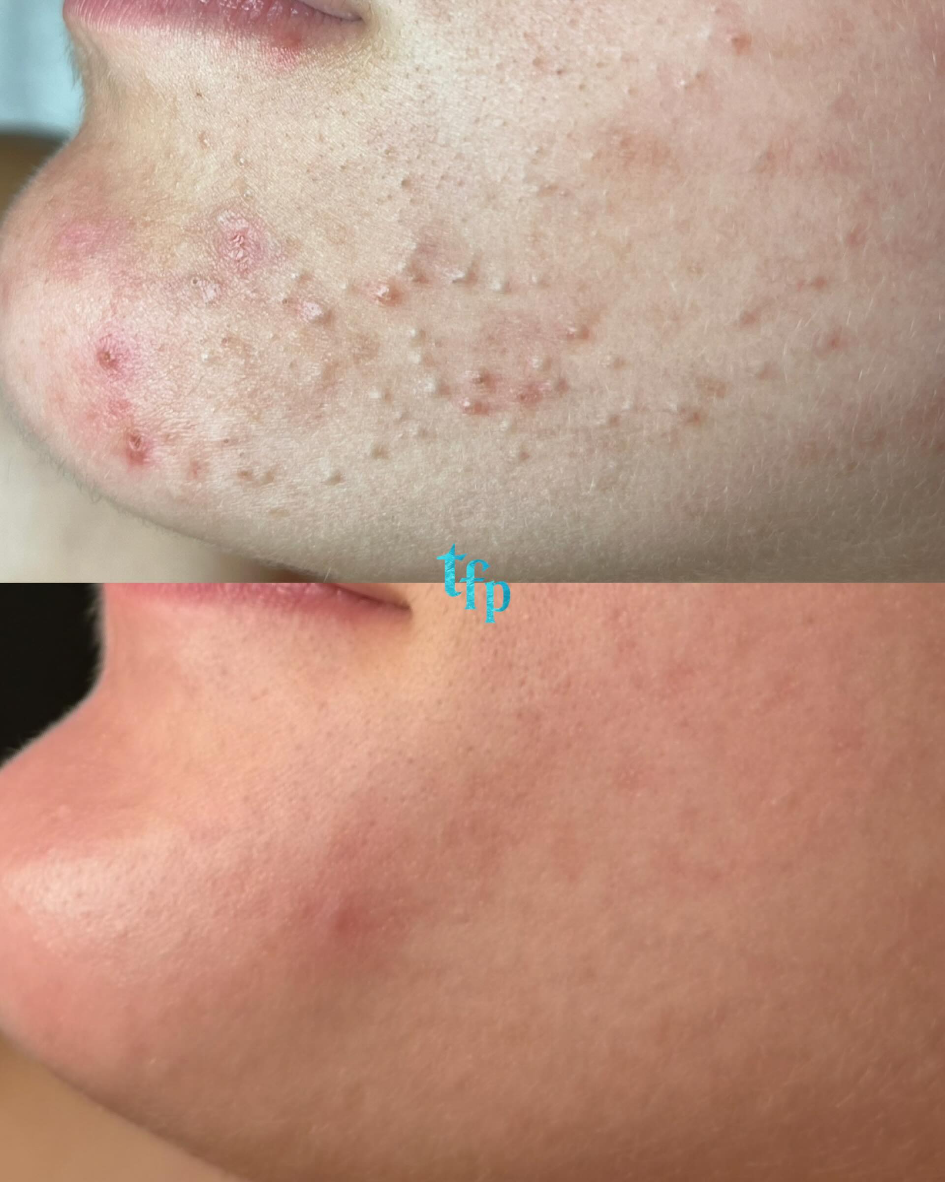 Little but strong 😩 non-inflamed acne like this is the hardest to clear and takes the longest!
🫧 What you need to clear it - absolutely NO pore clogging ingredients in your skincare, makeup or possible hair care. Use SartiSkincare and let me help you pick which exfoliant or active is best for your skin. Look at the acne safe makeup list on my blog on Thefaceplacemi.com
+
Acne bootcamp, or monthly acne facials with extraction only appointments in between sessions🐚
Let’s address this ➡️ Book on Thefaceplacemi.com
#acnemichigan#acnedetroit#noninflamedacne