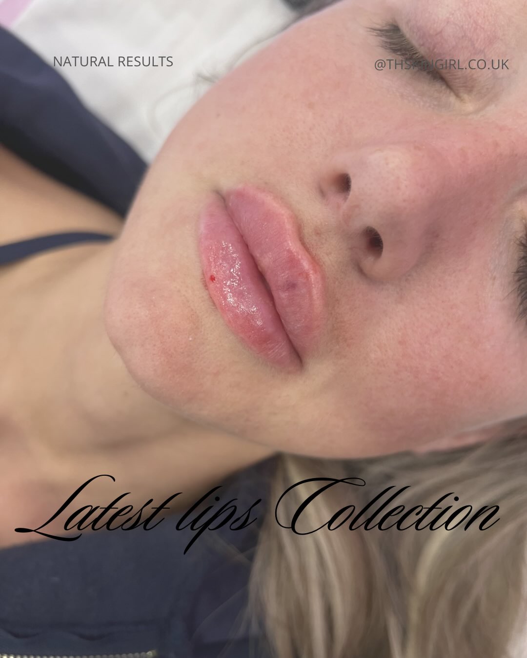 No lips are the same, each clients request is different and we respect that
Little and often is the way to go with minimal filler around the border. NB swelling and some bruising present
@lumifil_uk
