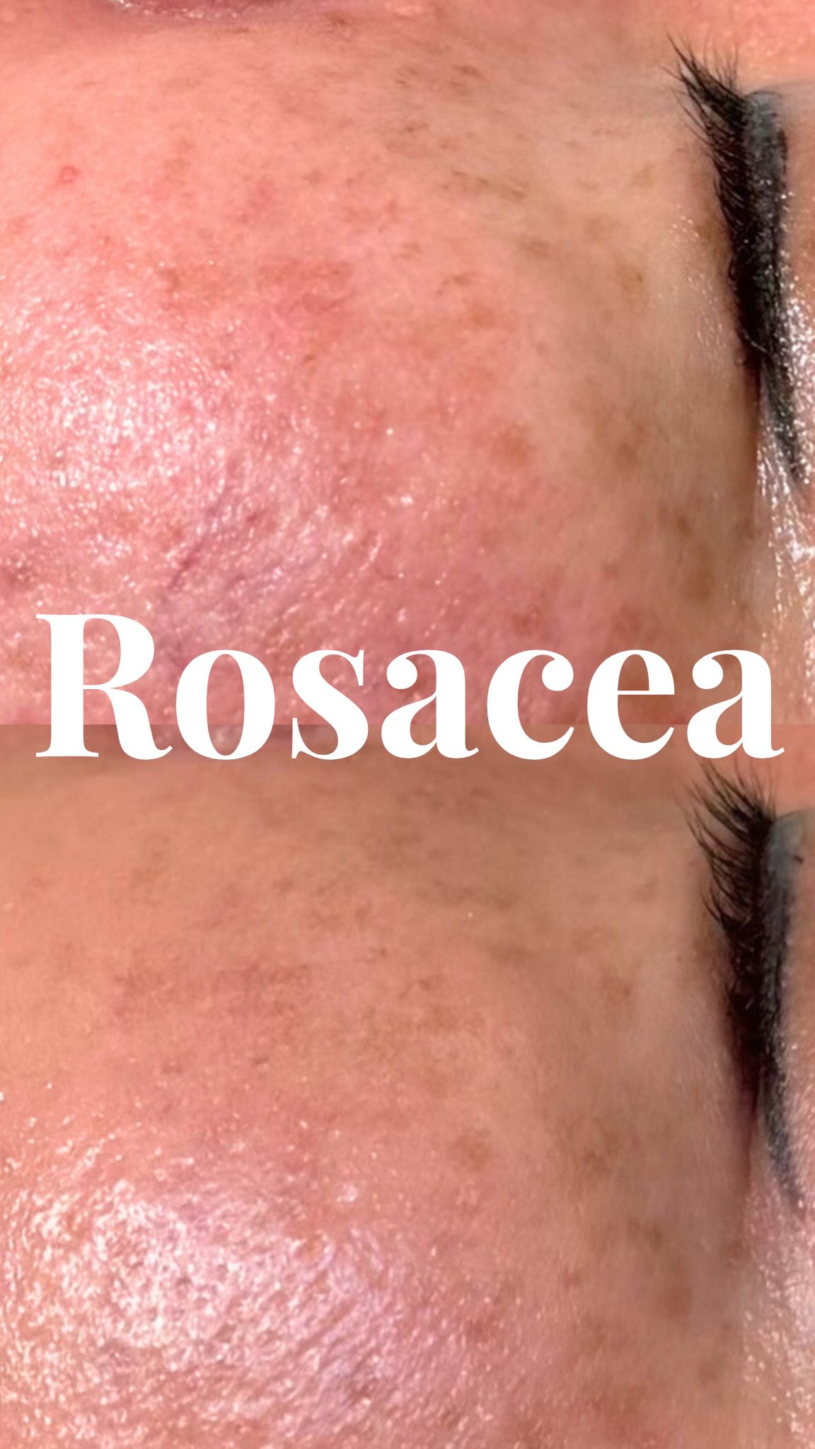 If you have rosacea, facials can feel intimidating.
The fear of leaving red, irritated, or inflamed is real. But you don’t have to avoid them anymore!
Cold laser facials are designed to calm sensitivity, support the skin barrier, and progressively strengthen rosacea-prone skin without the harsh irritation.
Book your calming, lifting and sculpting facial today ✨
#northyorkmedspa #coldlaser #lowlevellighttherapy #torontolaserfacials #northyorkskinclinic
