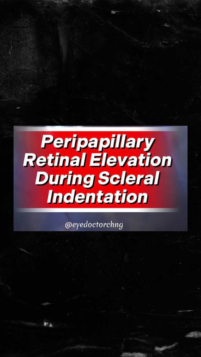 Interesting effect from indenting the scleral on the periphery to check for retinal tears during vitrectomy surgery in a highly myopic patient.
#vitreoretinalsurgery #ophthalmology #vitreoretinal #retina #eyedoctorchng