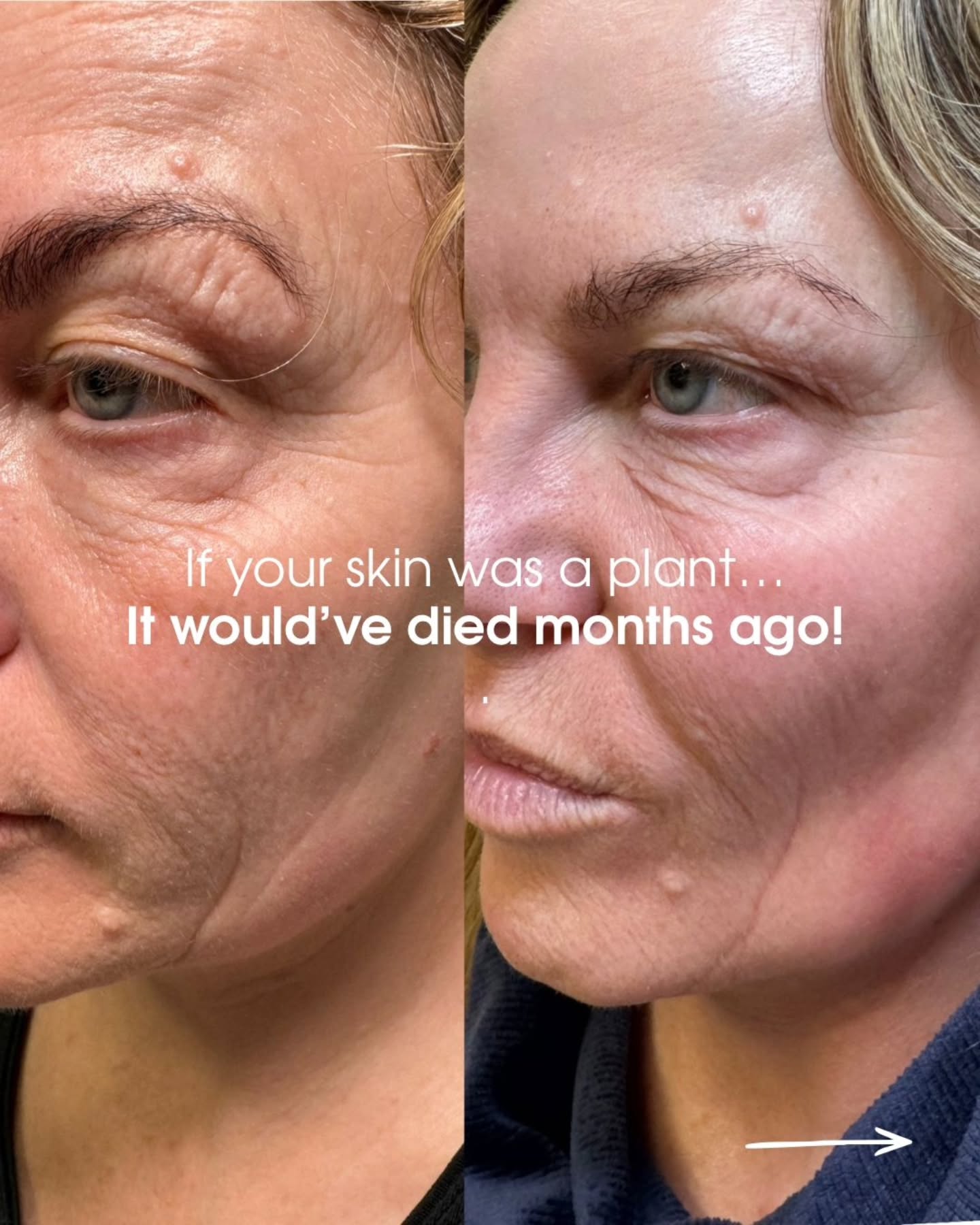✨ PROFHILO: THE SKIN BOOSTER YOUR SKIN WILL THANK YOU FOR ✨
If your skin feels dull, dehydrated, crepey, or lacking that healthy glow, it may not need more products—it may need hydration from within.
Profhilo is a unique skin booster made with pure hyaluronic acid that works beneath the surface to deeply hydrate the skin, improve texture, and stimulate collagen and elastin production.
💧 Deeply hydrates the skin
✨ Improves skin tone and texture
💫 Softens fine lines and crepey skin
🌿 Supports collagen and elastin production
🤍 Natural-looking results with no added volume
These before-and-after results show how improving skin quality can create a fresher, healthier, more radiant appearance—without changing your natural features.
Ready to give your skin the hydration boost it deserves? Send us a message to learn more about Profhilo and whether it's right for you.
#profhilo #skinboosterswarrington #hyaluronicacid #skinrejuvenation #glowingskin