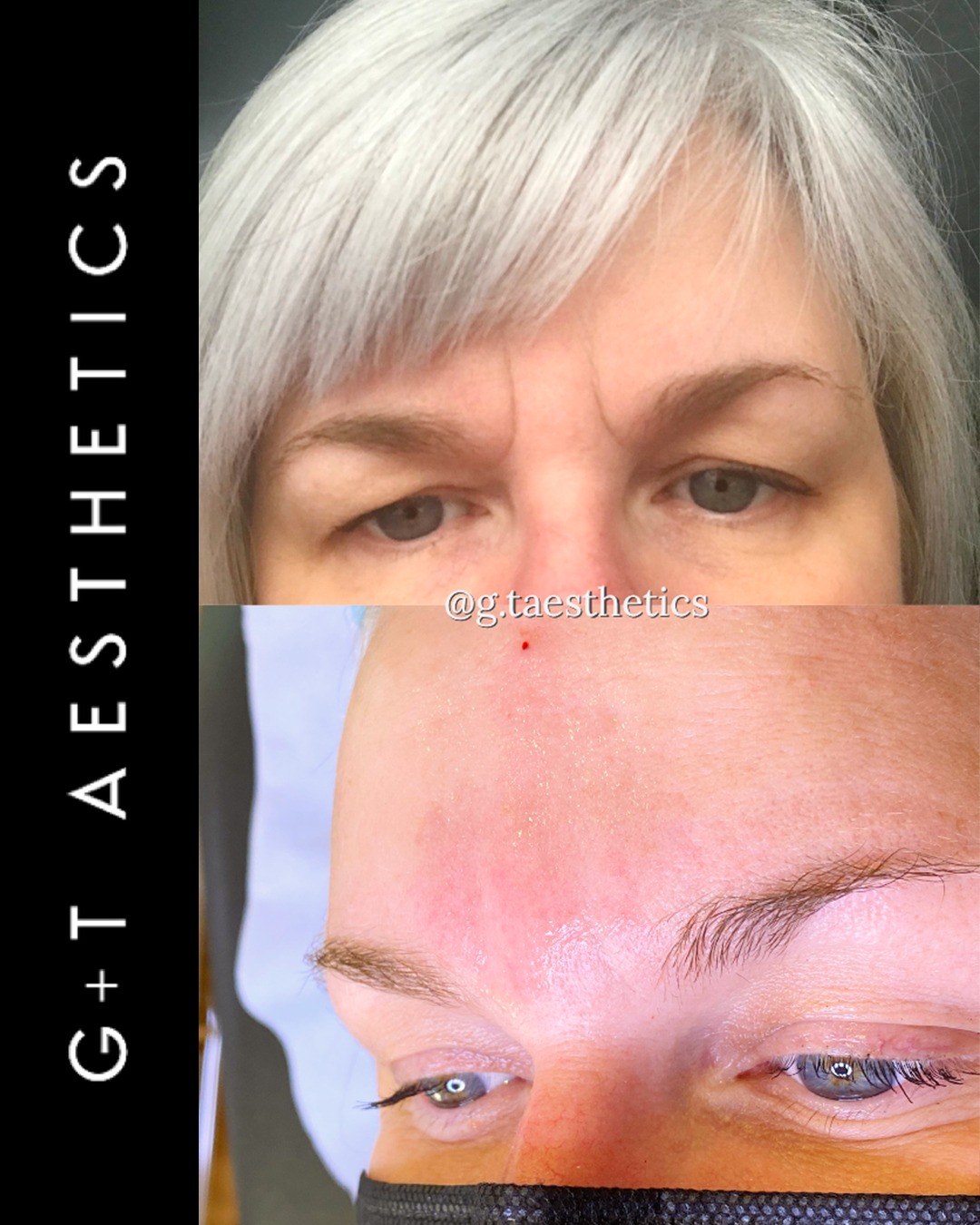 Subtle rejuvenation with a softer overall appearance. Dermal fillers can help improve deeper frown lines by restoring support beneath the skin while preserving natural facial movement.
📲Enquire or visit www.gtaesthetics.co.uk for more info.
#FrownLineFiller #DermalFillers #BeforeAndAfter #FacialRejuvenation #NaturalResults #GTAesthetics