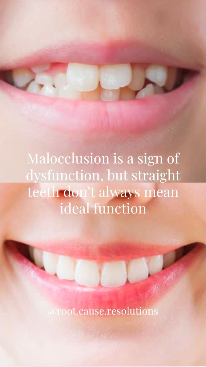 Orthodontics can create beautiful alignment, but if the underlying cause of the malocclusion wasn't addressed, the functional challenges may still be present.
When evaluating patients, consider looking beyond tooth position
✔️ How are they breathing?
✔️ Is the tongue resting on the palate?
✔️ Are lips comfortably sealed at rest?
✔️ Is there a history of snoring, mouth breathing, or sleep-disordered breathing?
✔️ Are there signs of restricted oral tissues or altered facial growth?
Airway, breathing, tongue posture, oral function, and facial development all play a role in long-term health outcomes. So the goal should be a healthy, functional system, not just straight teeth.
Comment ASSESSMENT to get a link to my self-assessment free download, designed for both providers and patients.
#sleep #wholebodyhealth #oralhealthcare #prevention #dentistry