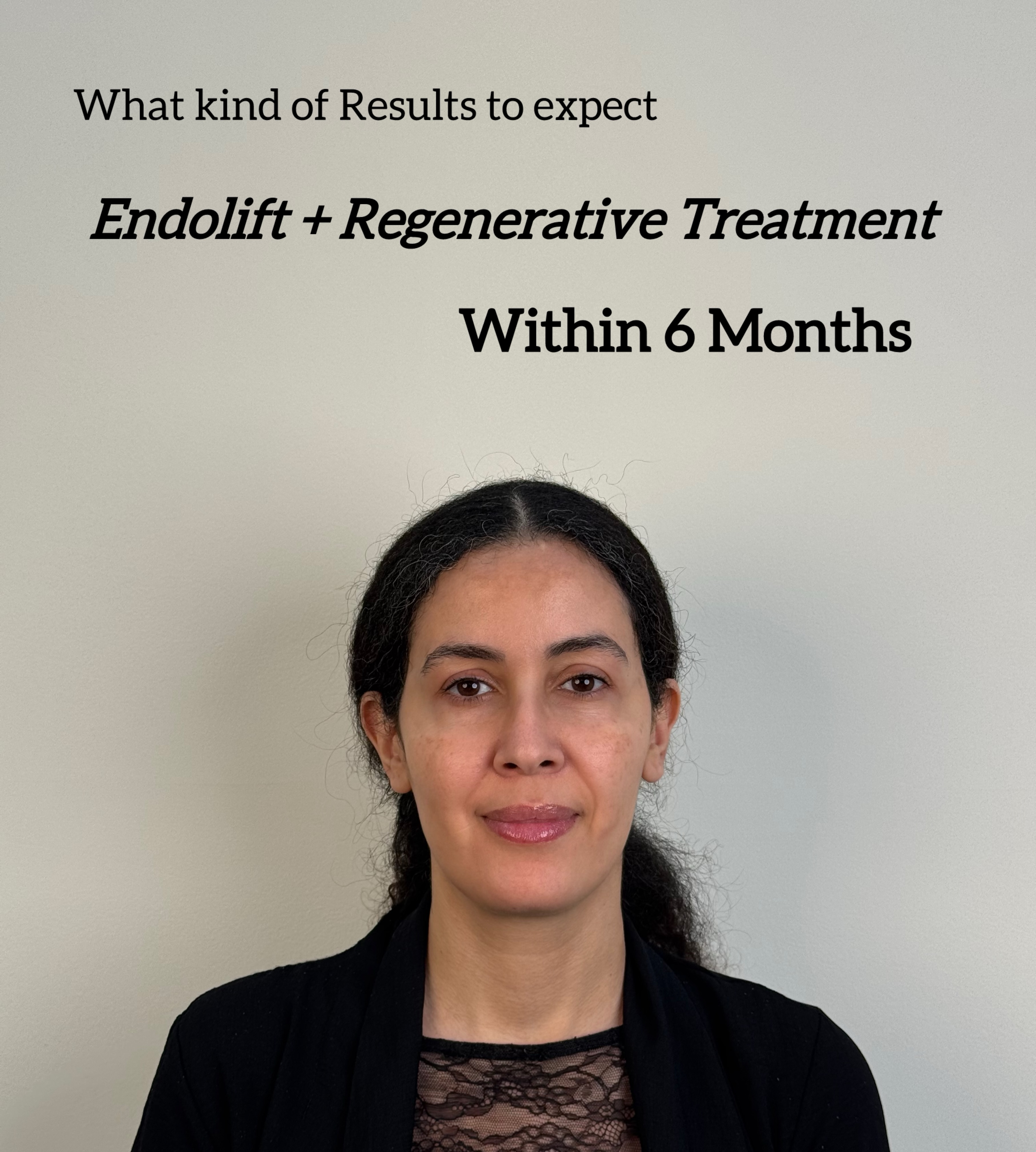 Treatment journey step by step for
🔺Structural , Subtle and Natural changes
🔺Focusing on Regeneration and Long Lasting results
Come from a
✅ Perfect planning
and
✅Perfect performing 😎
.
.
.
#endolift #endoliftdubai #regenerativetreatment