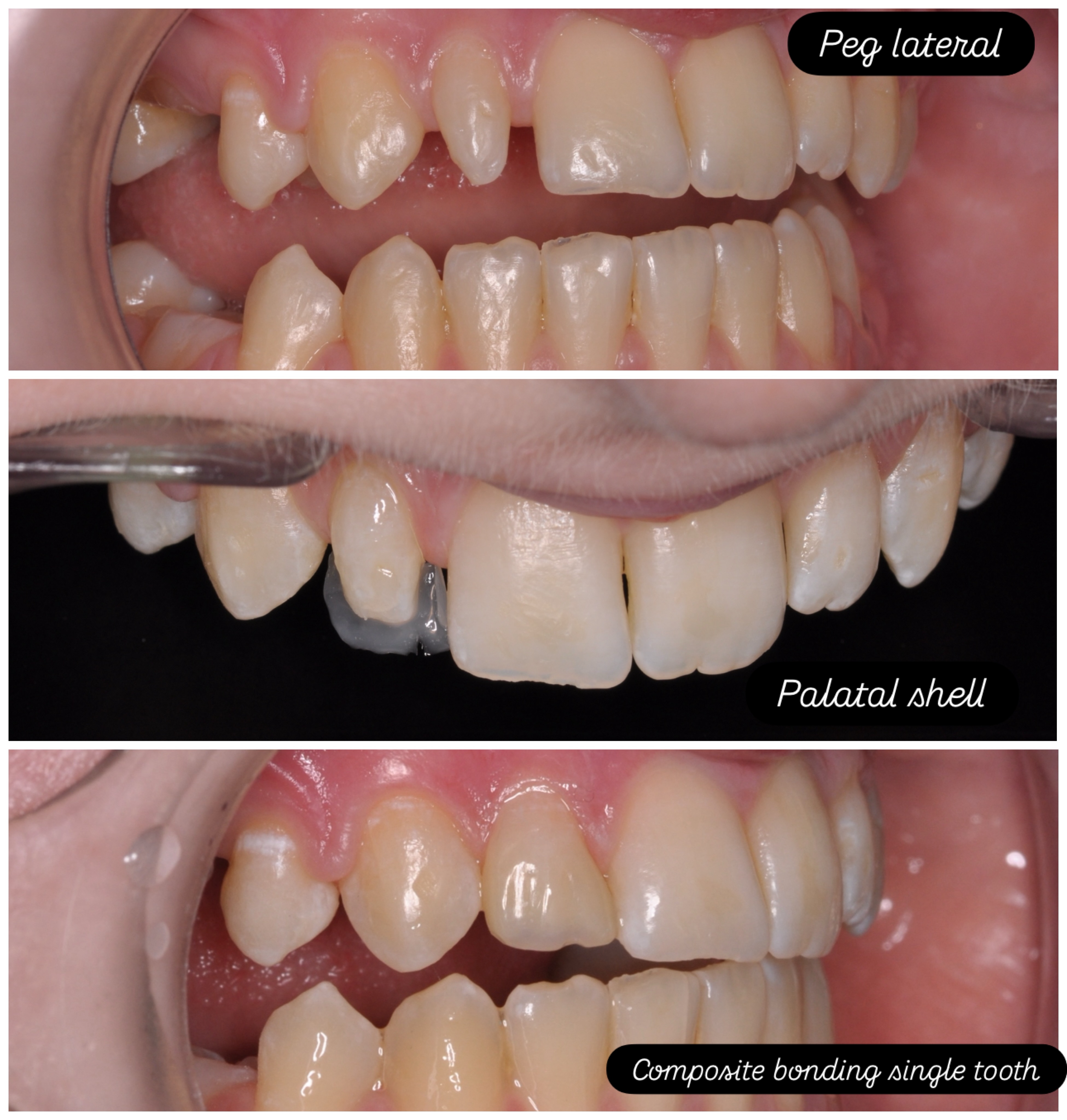 Free-hand composite bonding of peg lateral to enhance the smile in this teenager #compositebondingmanchester #smilemakeovermanchester #dentistprestwich #rootcanaltreatment #dentalimplants