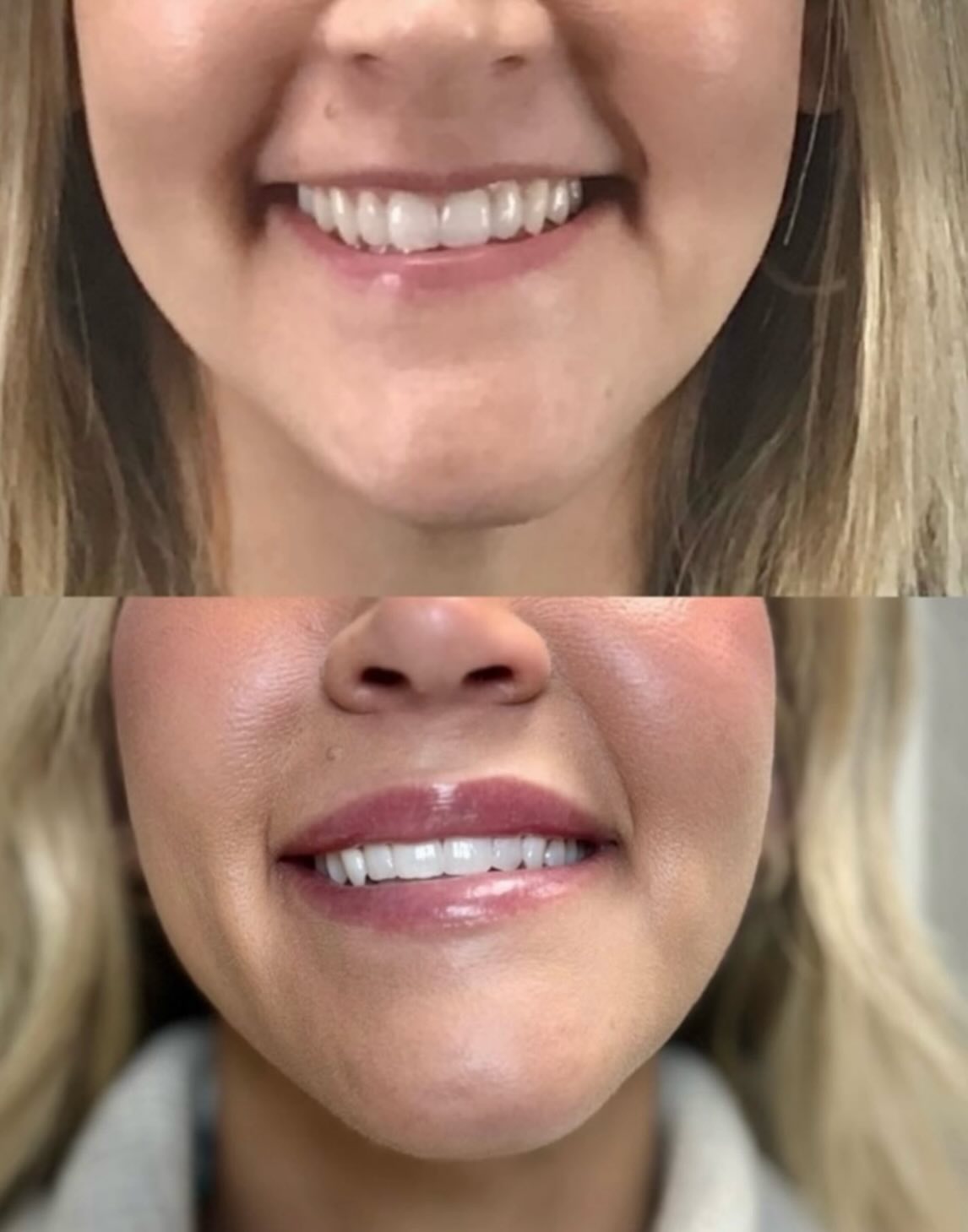 A subtle enhancement can make a beautiful difference. ✨
These Juvederm® Ultra lips added soft volume, improved shape, and enhanced overall balance while keeping a natural look.
Special Offer: $499
Regularly $550
Limited-time savings on Juvederm Ultra!!
