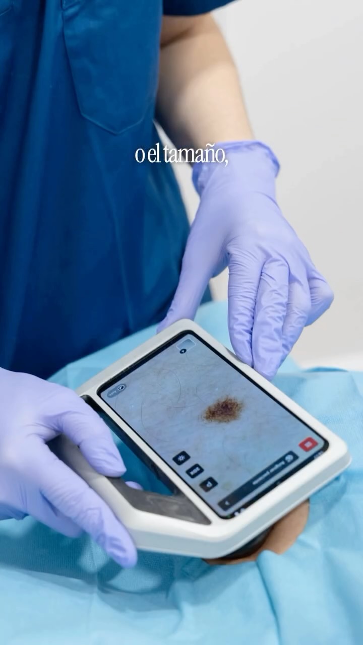 Los lunares pueden cambiar con el tiempo, y detectar esos cambios de forma precoz es fundamental.
La regla ABCDE nos ayuda a identificar signos de alarma que conviene valorar por un dermatólogo.
En Esthea Medica contamos con revisión y control de lunares mediante tecnología avanzada, de la mano de la @dra.mireiasegui.derma dermatóloga especializada en dermatoscopia y diagnóstico precoz del cáncer de piel.
Porque cuidar la piel también es revisarla.