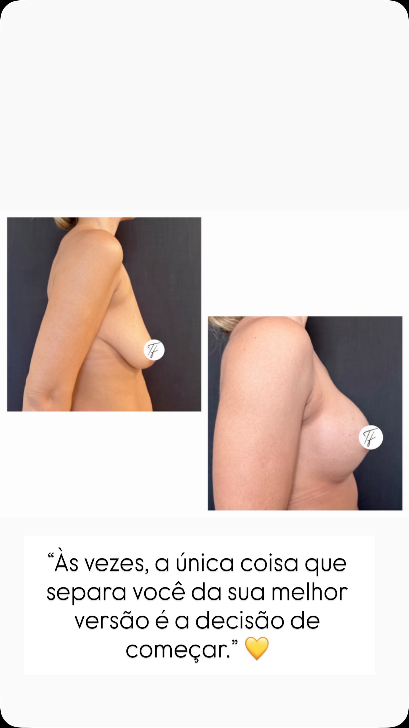 Hoje, durante uma consulta de acompanhamento de 6 meses, ouvi uma frase que ficou comigo.
Ao olhar suas fotos de antes e depois, ela disse:
“Eu só consigo pensar em uma coisa: por que eu não fiz isso antes?”
E essa é uma pergunta que escuto mais vezes do que imaginam.
Não porque a cirurgia seja apenas uma mudança estética, mas porque ela representa o fim de algo que incomodava diariamente. O fim da insegurança, do desconforto, das limitações e da sensação de não se reconhecer completamente.
Ela me contou que hoje se sente diferente. Mais leve, mais feliz, mais confiante. E que a única dúvida que tem é por que demorou tanto para tomar essa decisão.
Ver uma transformação física é gratificante. Mas presenciar a transformação da forma como uma mulher se enxerga e vive a própria vida é, sem dúvida, a parte mais especial do meu trabalho.
É por isso que faço o que faço todos os dias. ✨