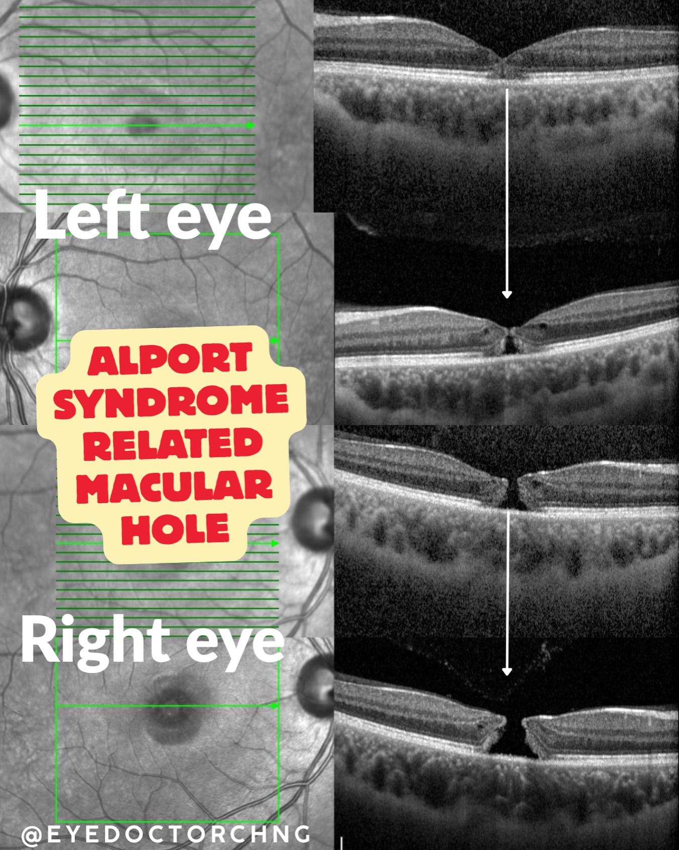 Alport Syndrome is a genetic condition caused by mutations in COL4A3, COL4A4 or COL4A5 genes that leads to a loss of type IV collagen from basement membranes in the kidneys, ears and eyes.
Classic triad of signs and symptoms:
- Progressive kidney failure
- Sensorineural hearing loss
- Ocular abnormalities (up to 70% of patients)
Common ocular findings include:
- Anterior lenticonus (virtually pathognomonic)
- Perimacular dot-and-fleck retinopathy
- Temporal retinal thinning on OCT
Macular hole can happen but rare. It is caused by severe thinning of the internal limiting membrane (ILM) and nerve fiber later due to the lack of the α3α4α5 collagen IV network that is normally present in the ILM. This leads to progressive temporal macular thinning and eventually result in a giant macular hole. Reported surgical outcome with vitrectomy has variable success rates.
#AlportSyndrome #MacularHole #Ophthalmology #retina #eyedoctorchng