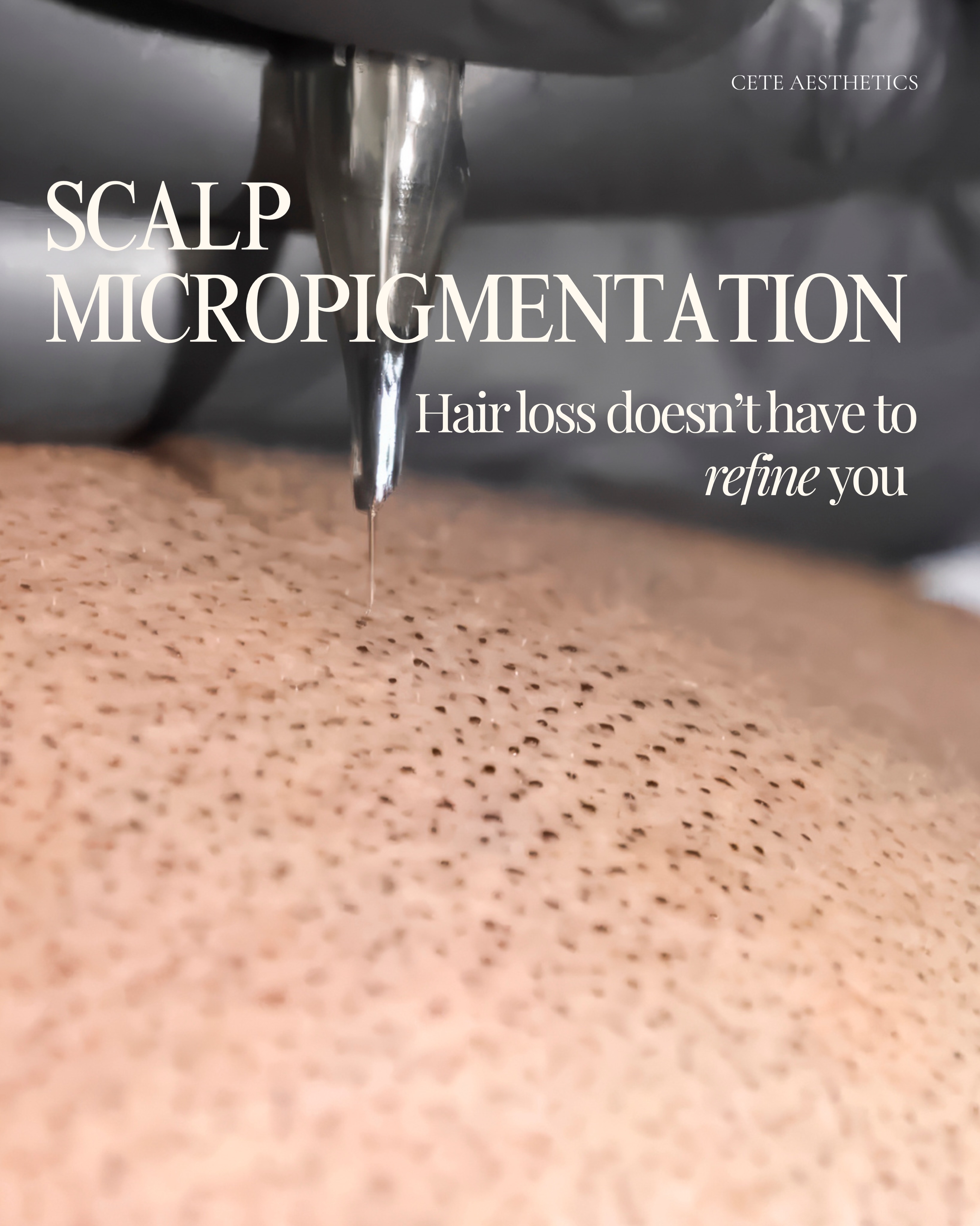 Hair loss affects confidence more than most people realise.
Scalp Micropigmentation is a non-surgical solution that creates the appearance of a fuller scalp, sharper hairline, and increased density using advanced pigment implantation techniques.
Whether youโre experiencing thinning hair, a receding hairline, alopecia, or scalp scarring, SMP could be the solution youโve been looking for.
DM โSMPโ to book your consultation or visit our website to book an appointment
โโ
#ScalpMicropigmentation #SMPUK #HairLossSolution #HairlineRestoration #ScunthorpeBusiness