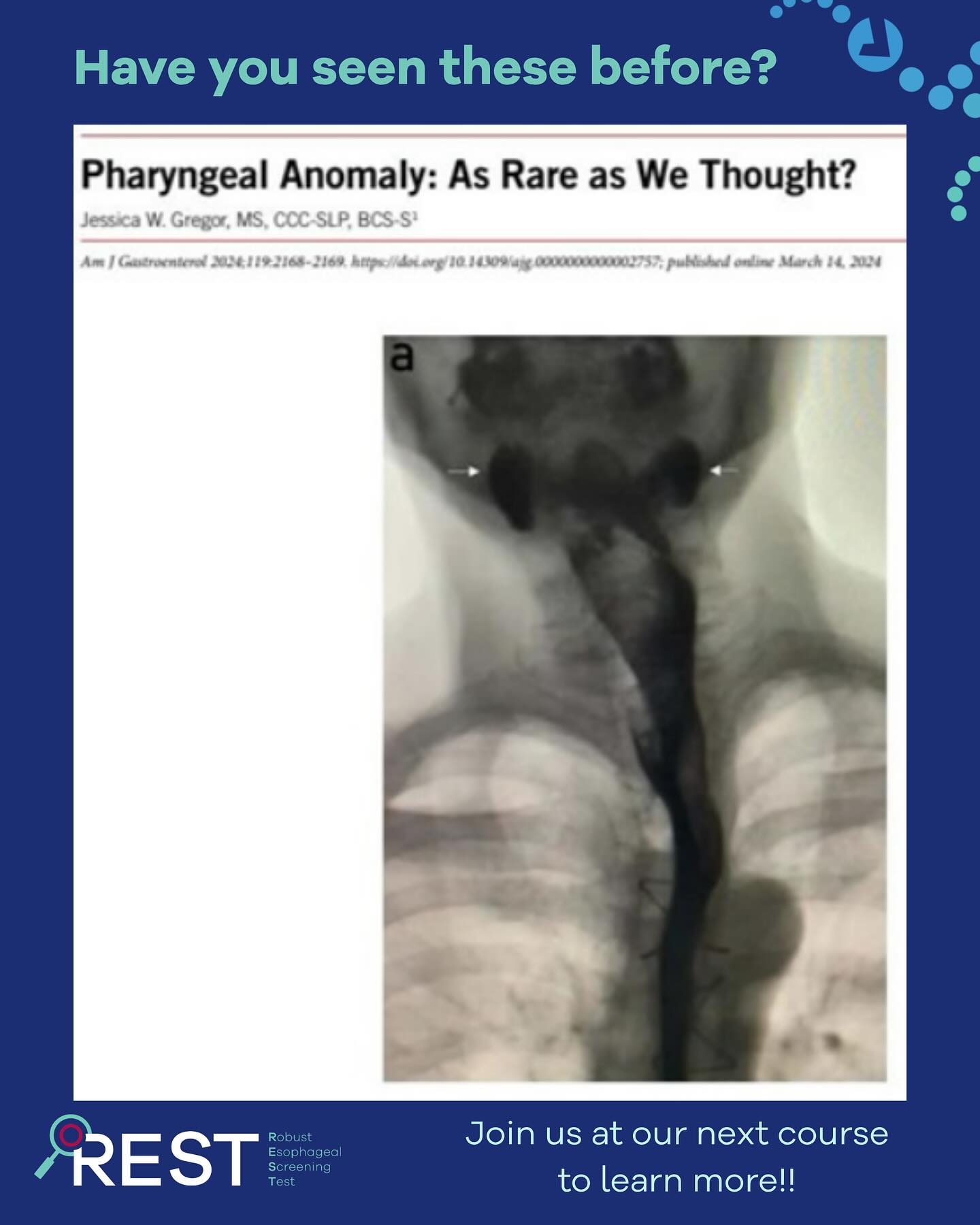 Have you seen these anomalies before? 🧐 Drop a comment below! They are, in fact, very common.
The REST 🔍 protocol can help uncover hidden outpouchings that reflect a weakened pharynx, which can have implications for pharyngeal efficiency and safety.
Come learn more about these anomalies at our next course *9/19/26* and get trained in a clinical competency that will change the game for your dysphagic patients! 🧠
Visit www.esophagealcolab.com to learn more about us and see our offerings!
